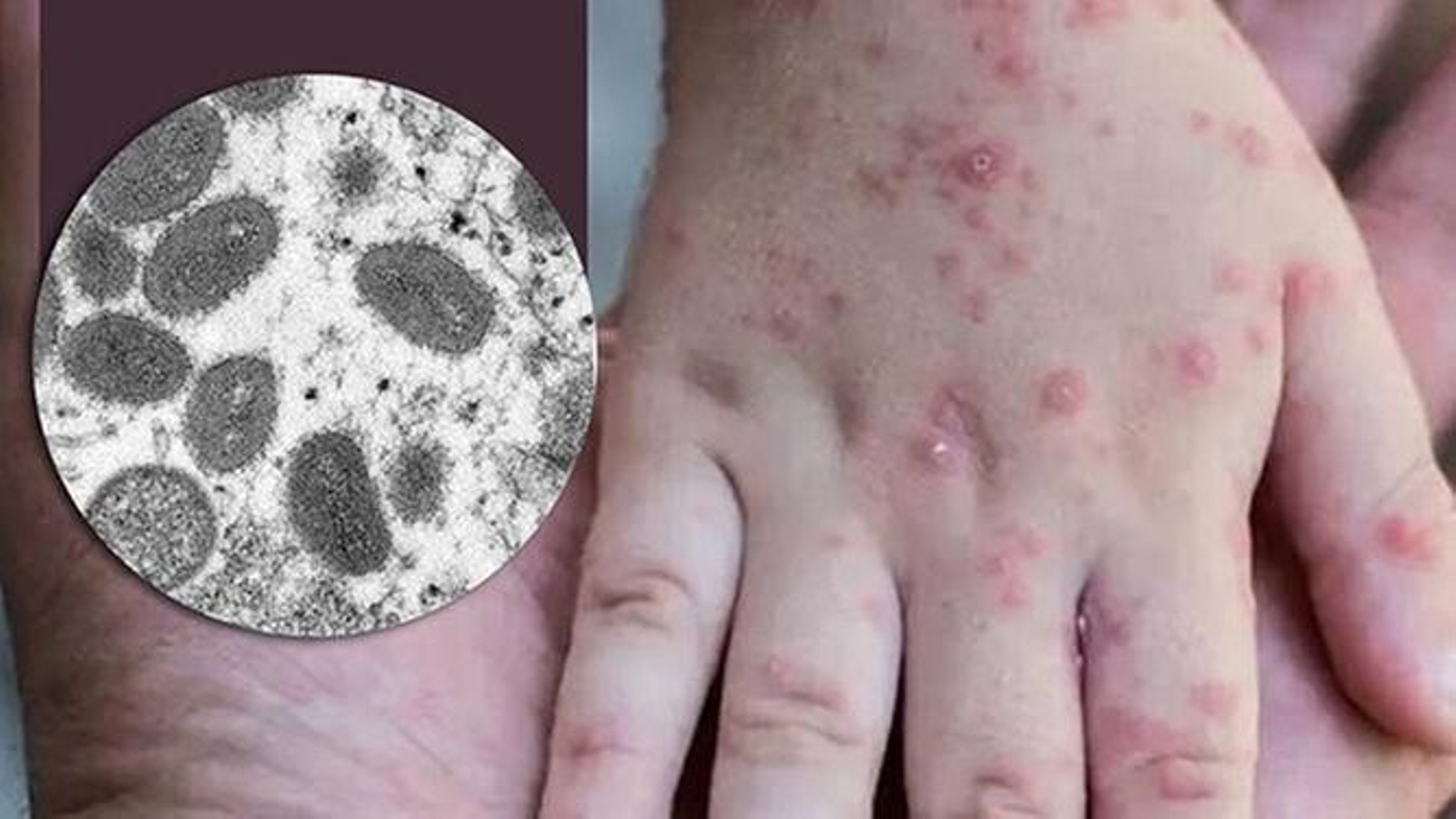 Efectos en la piel de la viruela del mono.