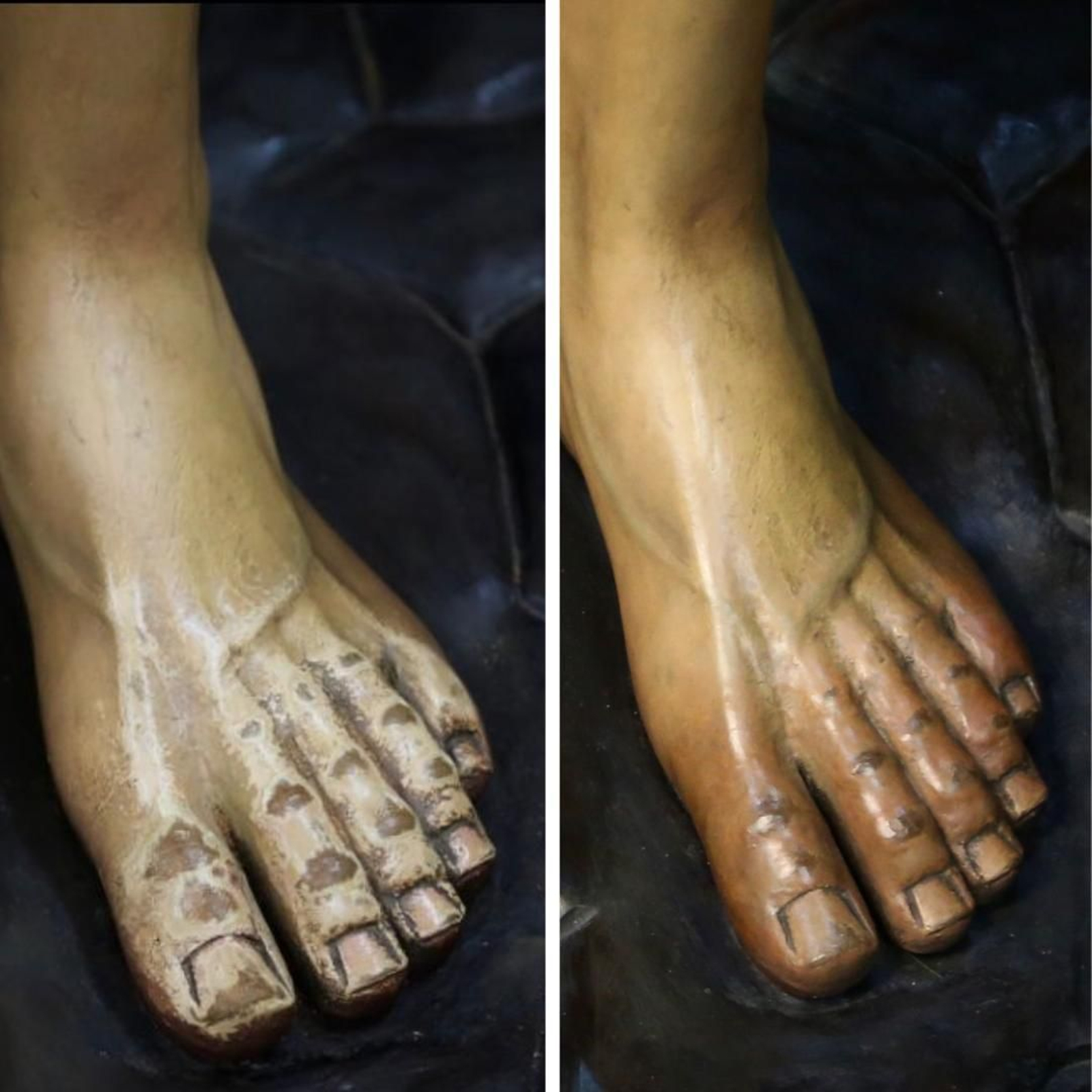 El antes y después de los pies tras la intervención