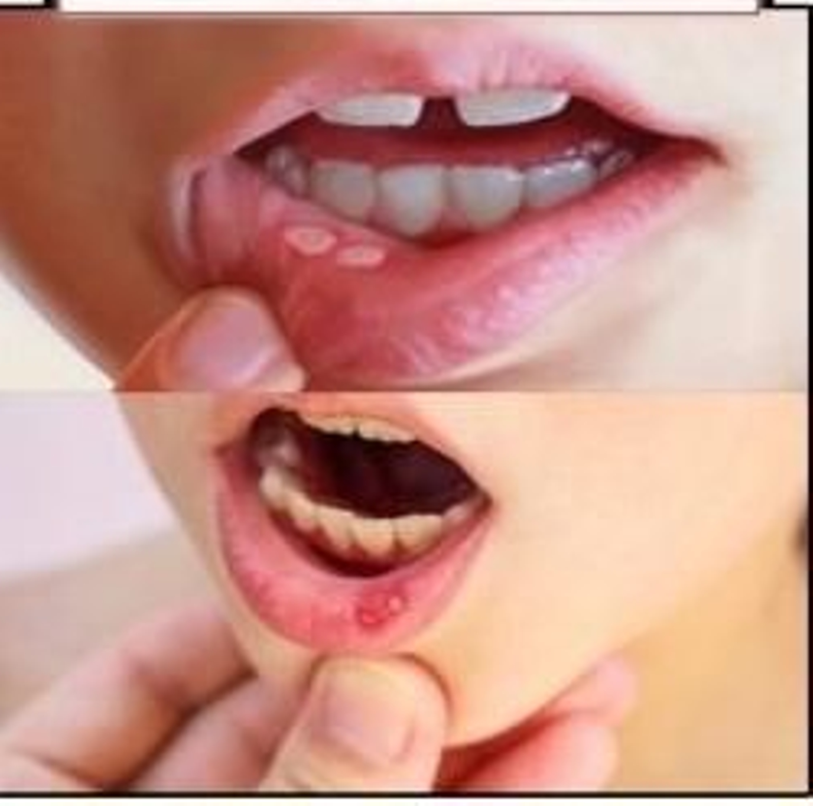 La estomatitis aftosa, síntomas de la infección recurrente en niños tras el fin de las mascarillas