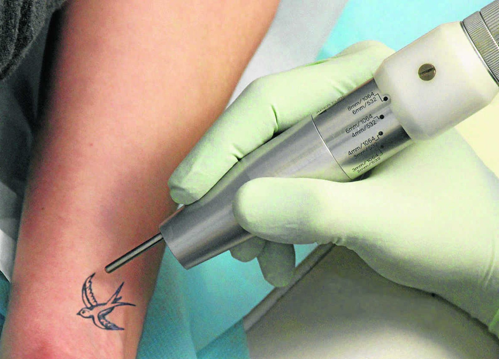 Todos aquellos que se arrepienten de un tatuaje del pasado pueden recurrir al laser.