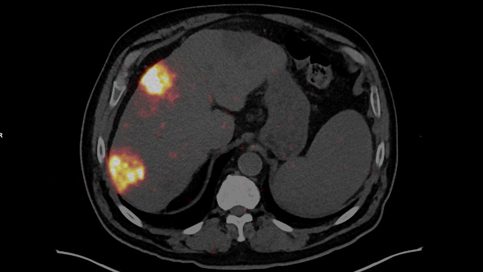 Terapia intervencionista para tratar un carcinoma hepatocelular