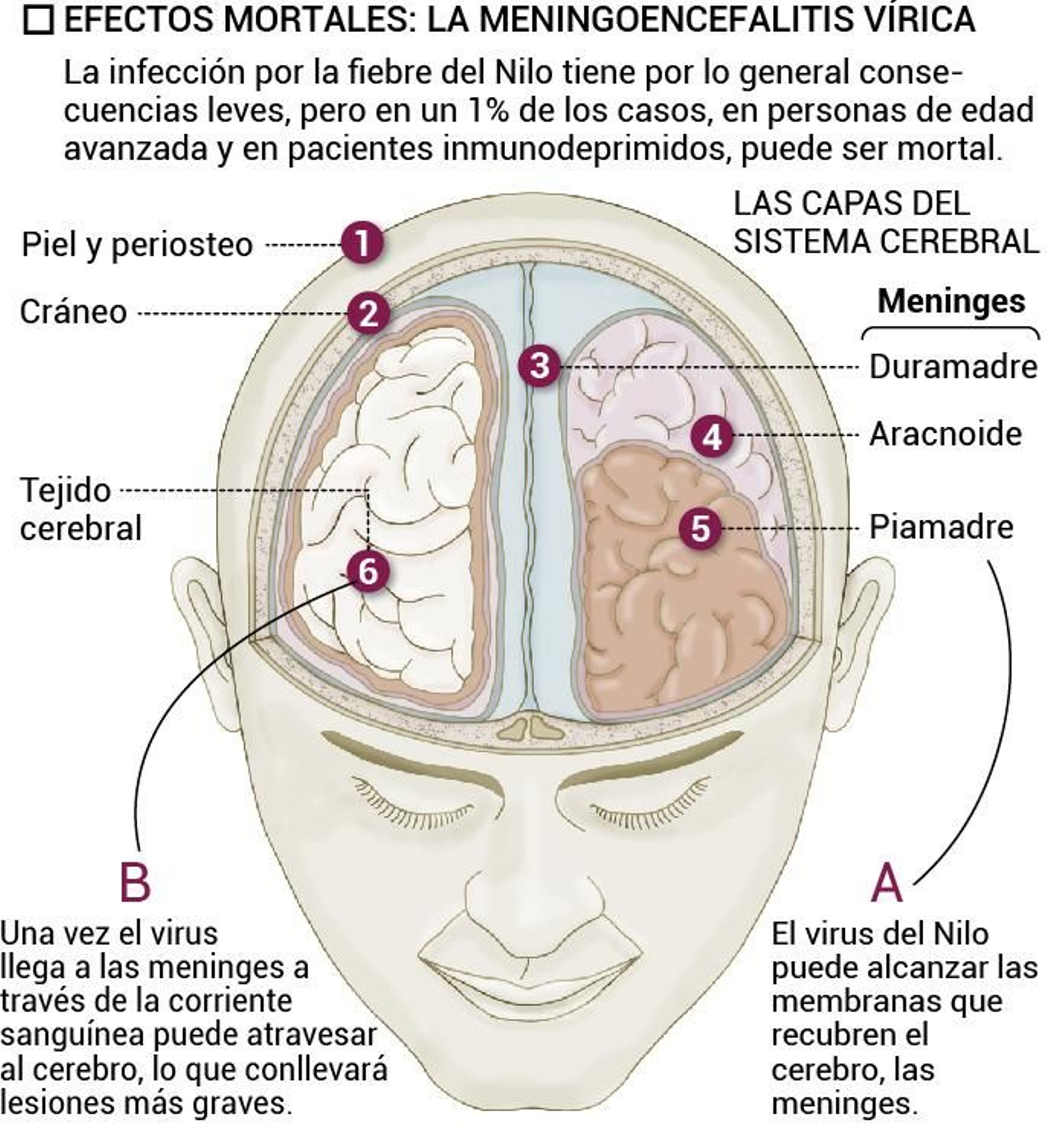Meningitis por el Virus del Nilo