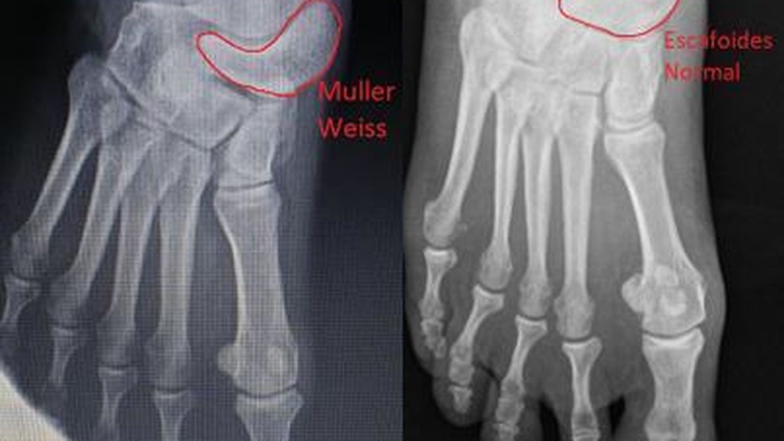 Comparación del escafoides con y sin síndrome de Müller-Weiss