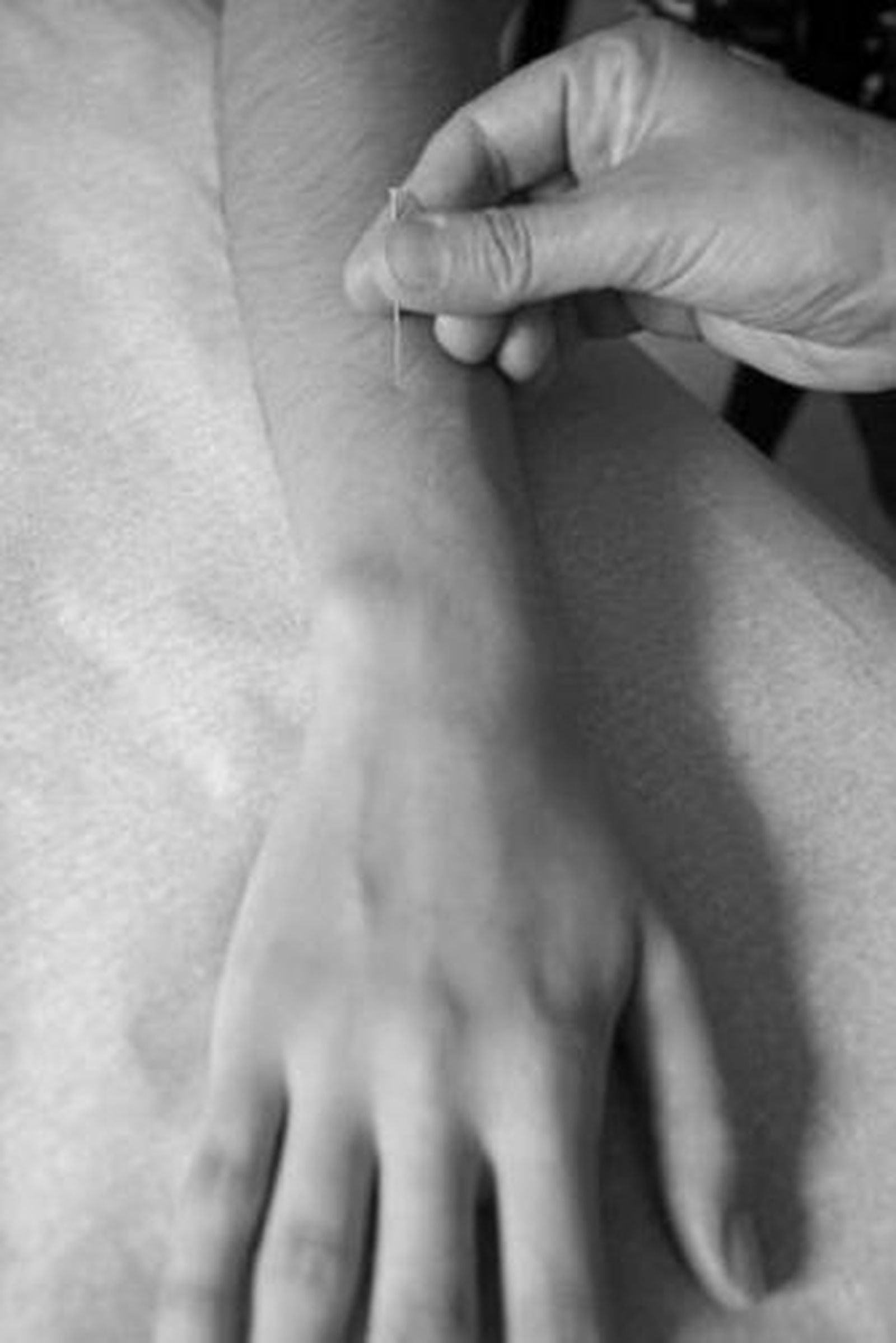 Las agujas se colocan en diez puntos por sesión.