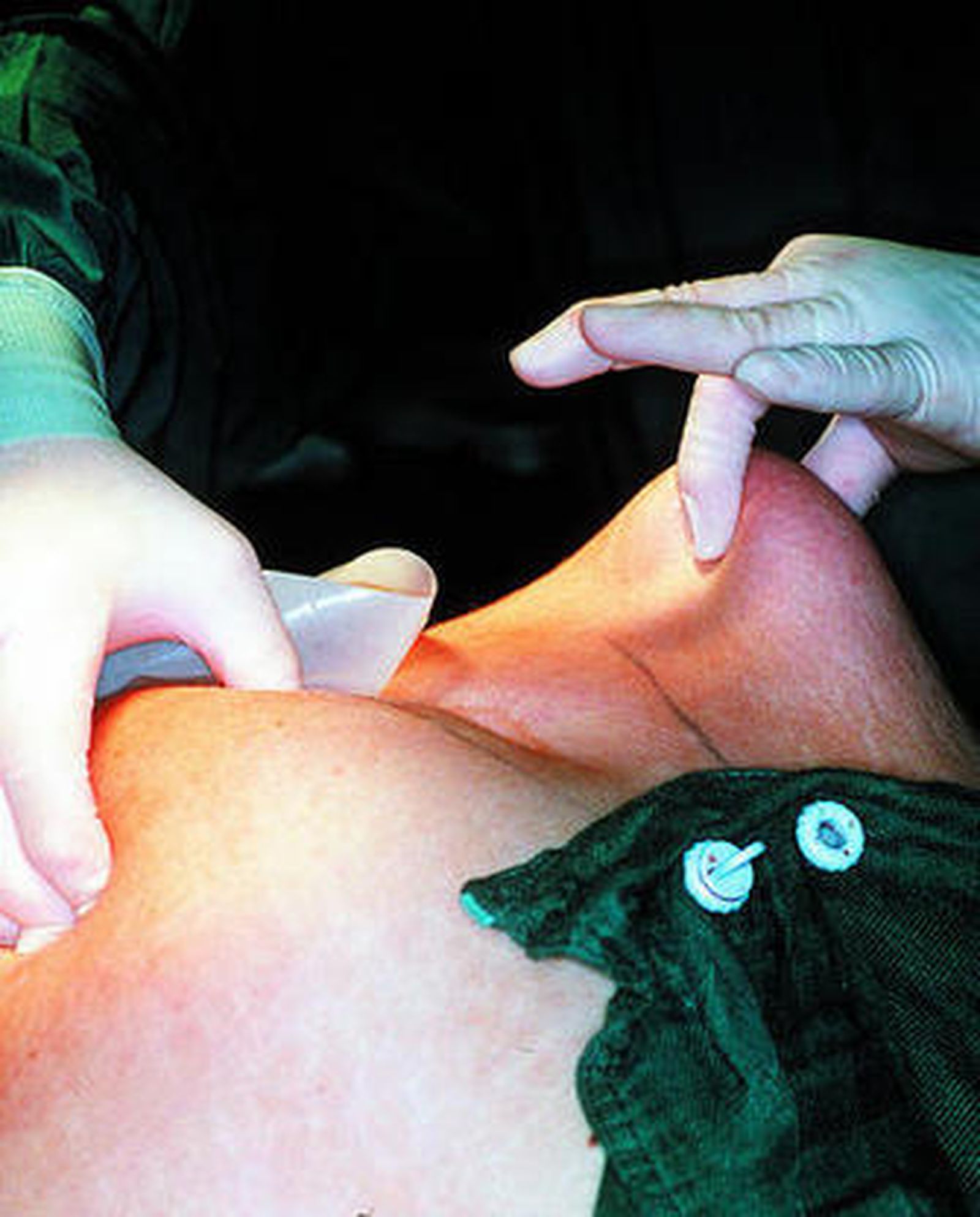 Una operación de cirugía estética.