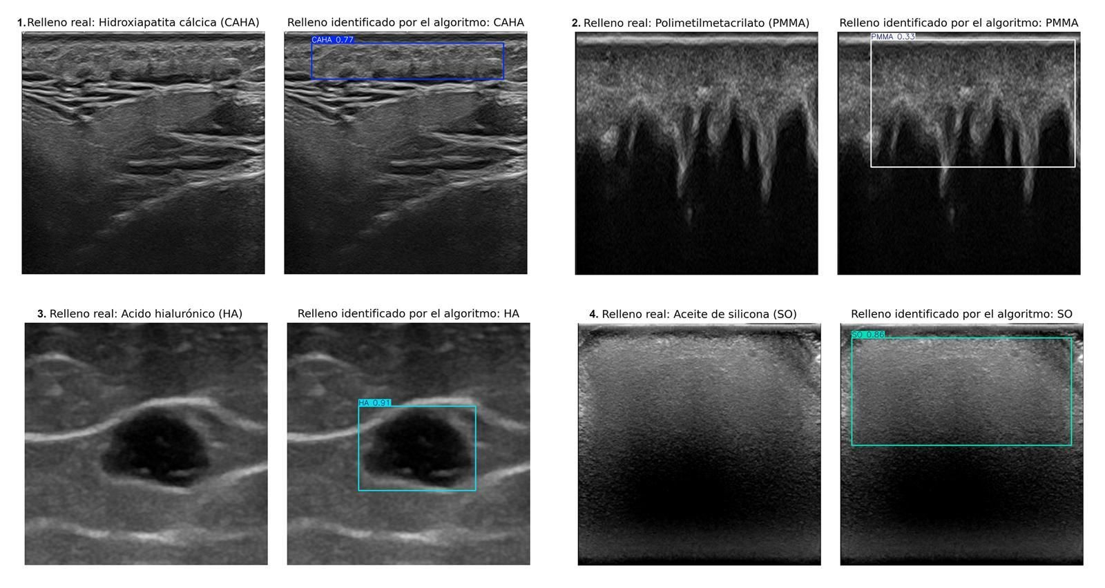 Imagen remitida por la UGR sobre este sistema de IA que permite identificar rellenos estéticos.