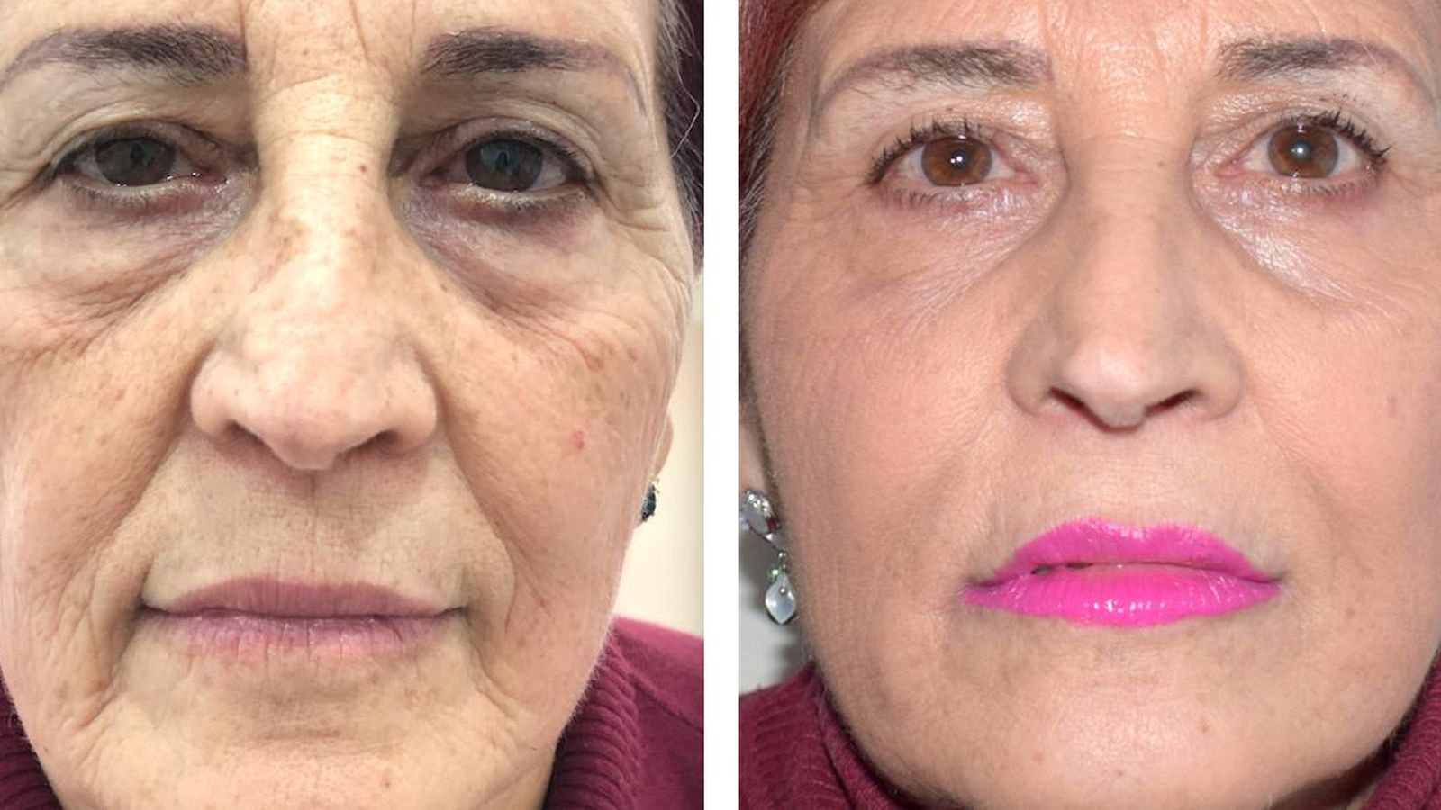 Rejuvenecimiento global del rostro con técnica 4x9 sin cirugía Dr. Kosmecki (Clínicas Verkomed).