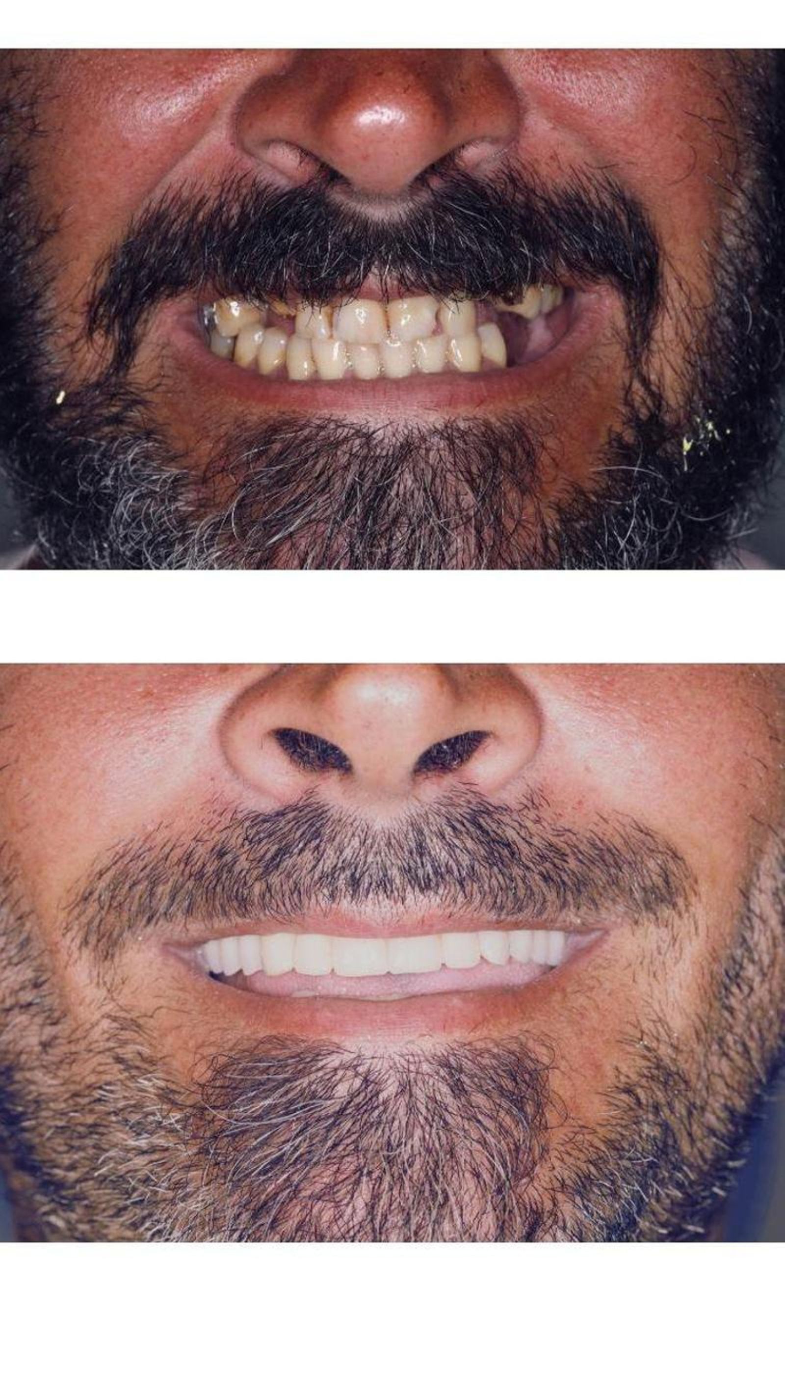 Antes y después de la aplicación de esta técnica de All-on-4.