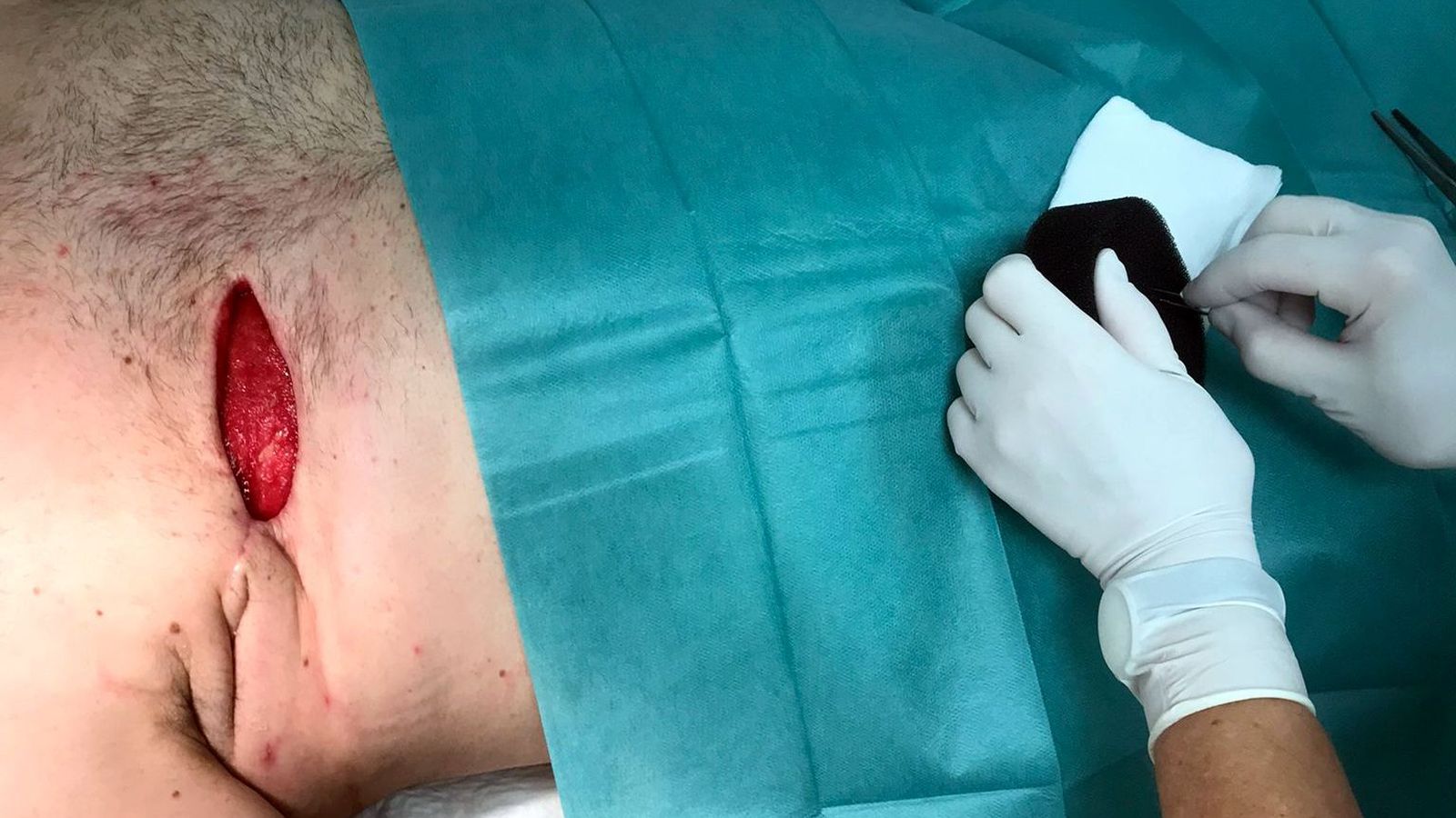 Abordaje por parte de Agustina Rosselló, EPAHCC de Valme a una herida de cáncer de mama en varón.