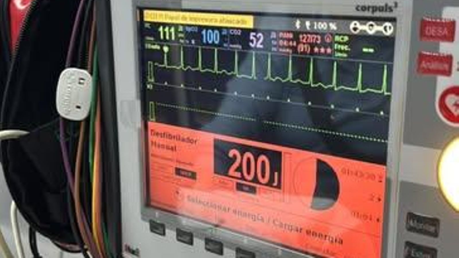 Panel de electrocardiograma realizado al paciente. Panel de electrocardiograma realizado al paciente.
