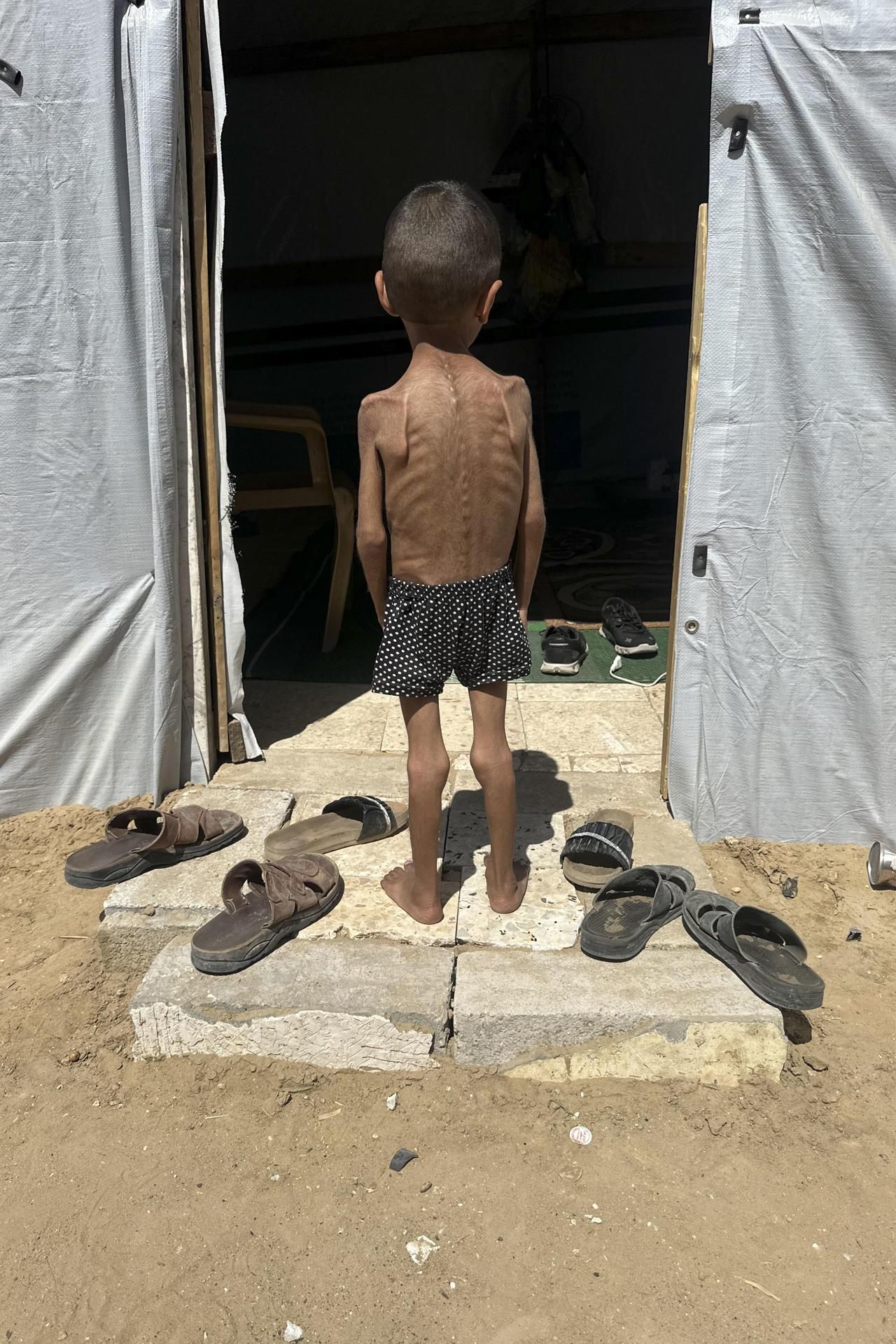 Hasta 80 niños han muerto por desnutrición en la Franja de Gaza desde el inicio de la ofensiva