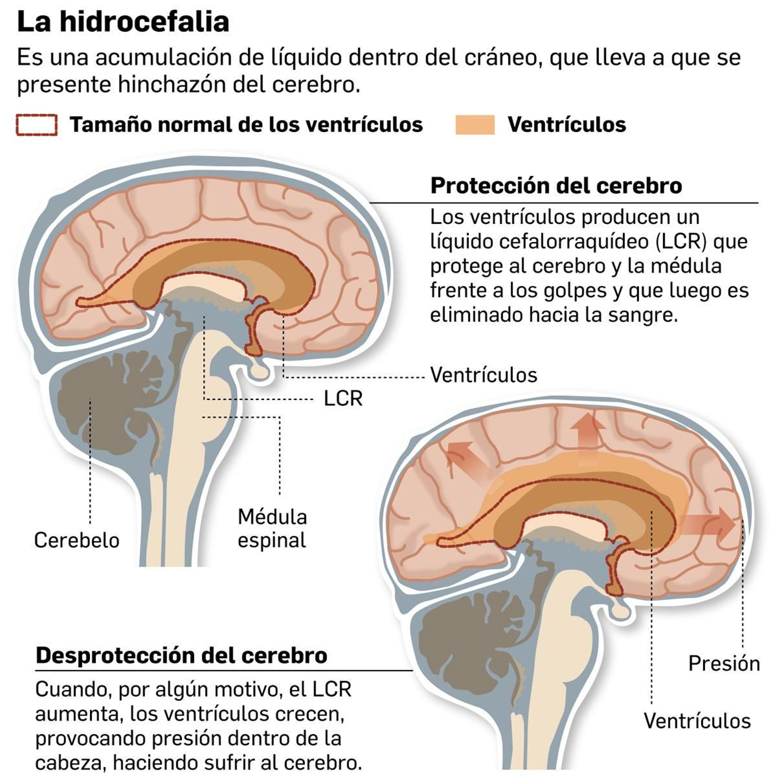 01-infografia-explicacion-hidrocefalia