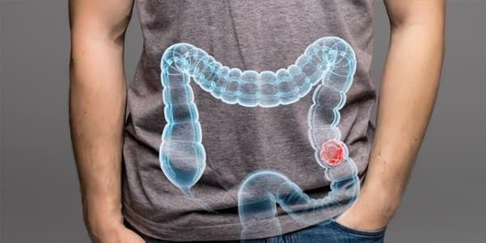 El descubrimiento permitirá desarrollar nuevos tratamientos contra el cáncer colorrectal. El descubrimiento permitirá desarrollar nuevos tratamientos contra el cáncer colorrectal.