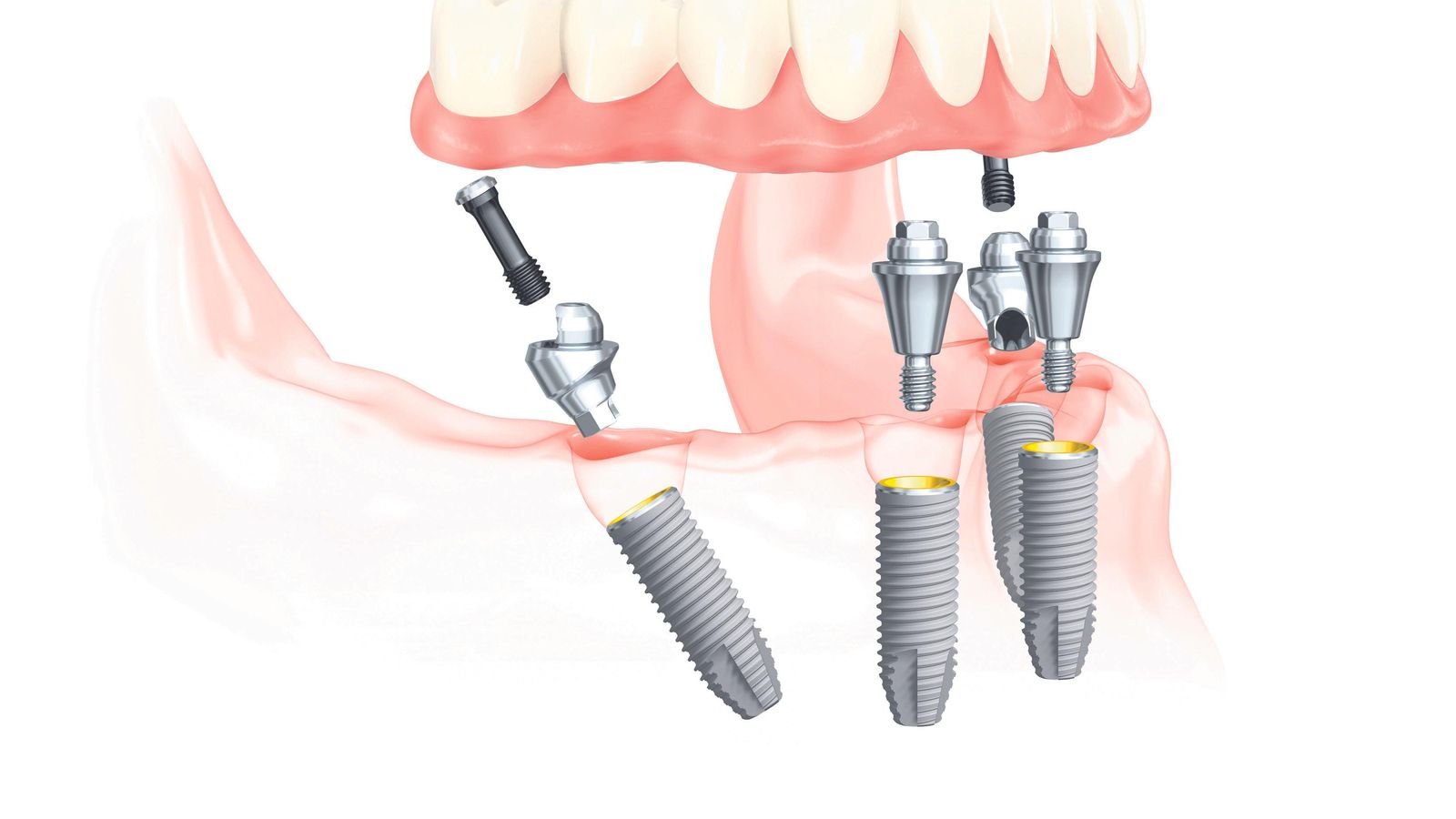 utiliza técnicas que permiten la colocación de piezas dentales en una sola jornada.