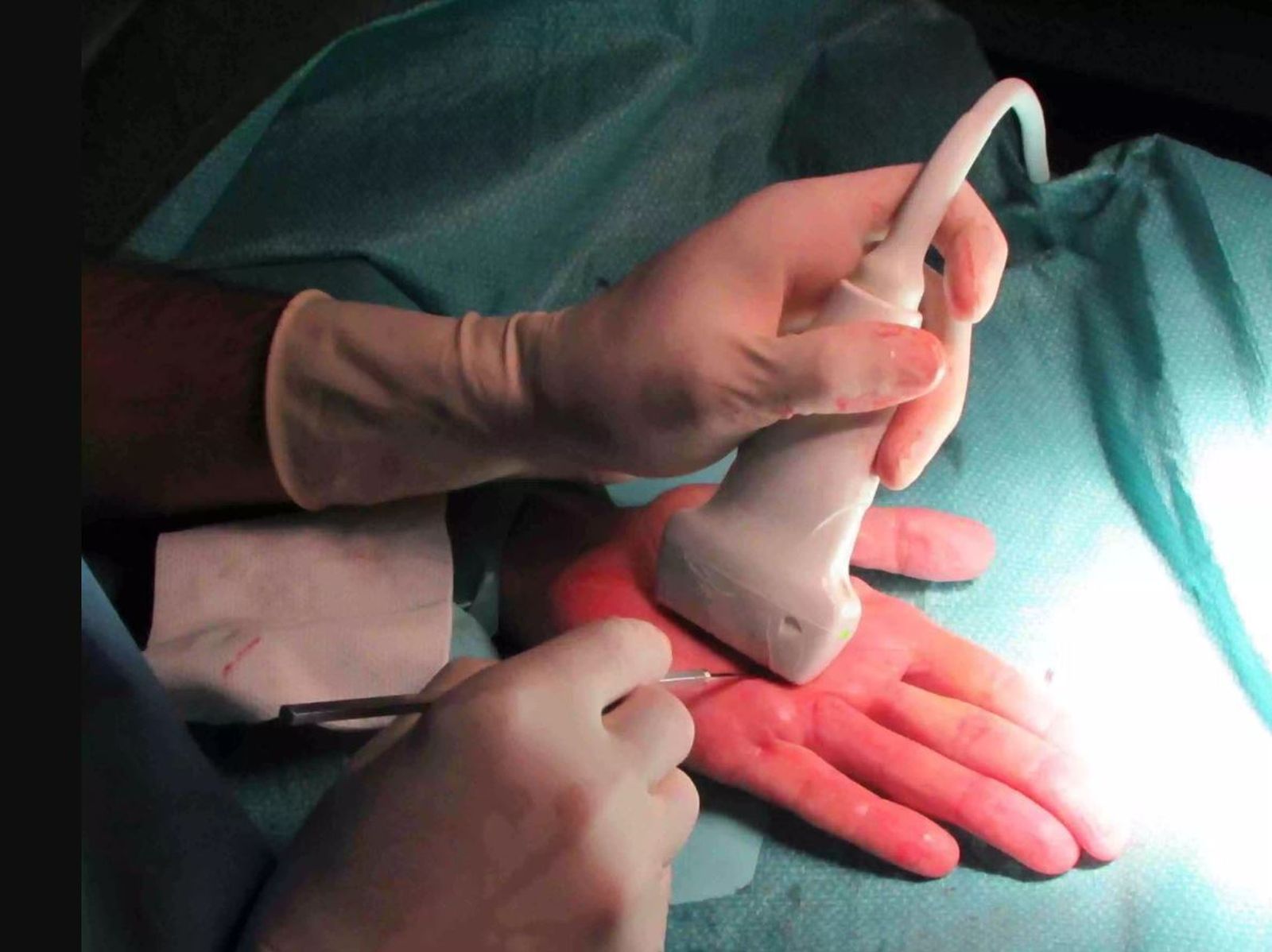 Fasciotomia ecoguiada para tratar esta enfermedad en un paciente.