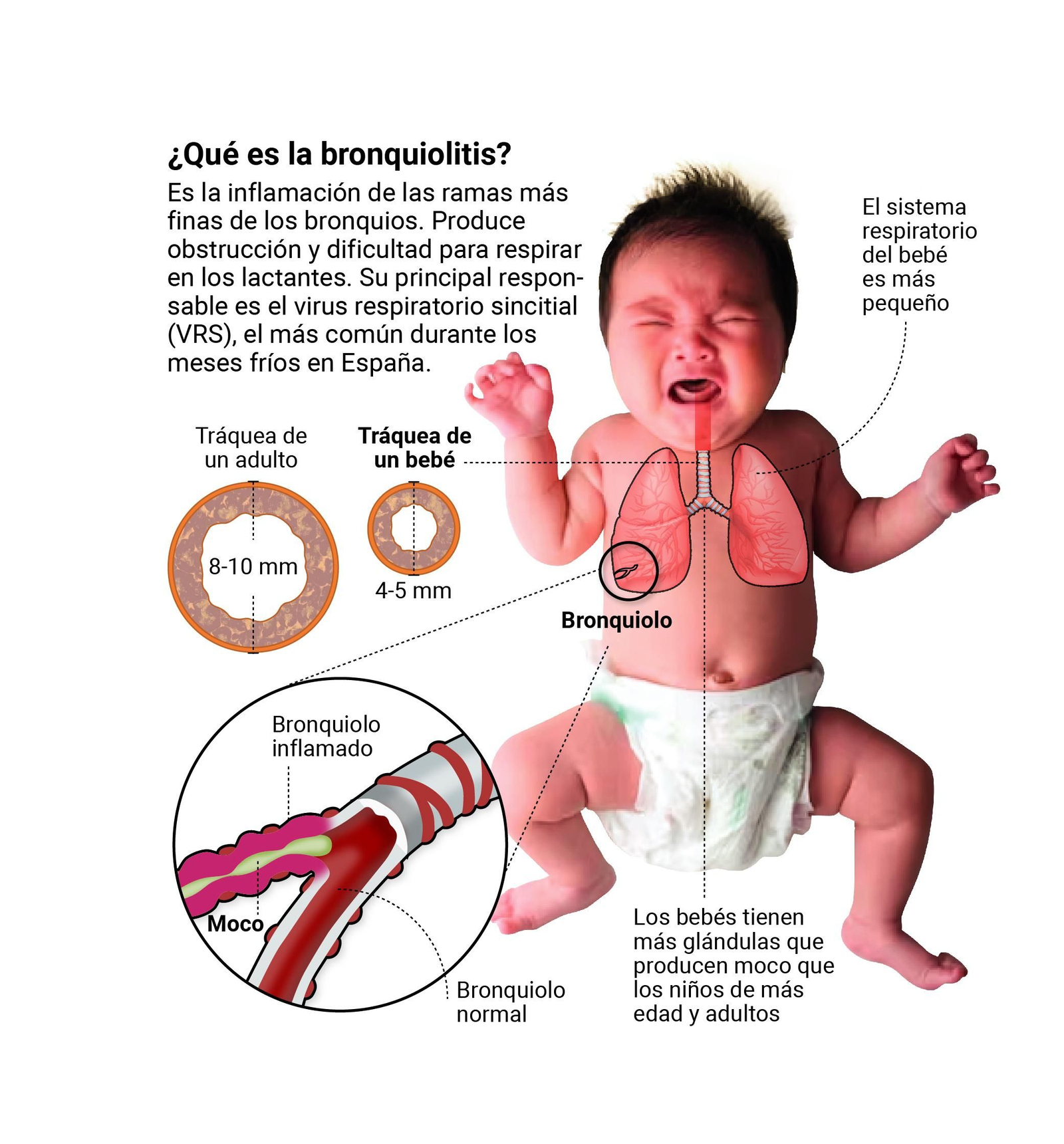 Qué es la bronquiolitis. Fuente: Andavac Qué es la bronquiolitis. Fuente: Andavac