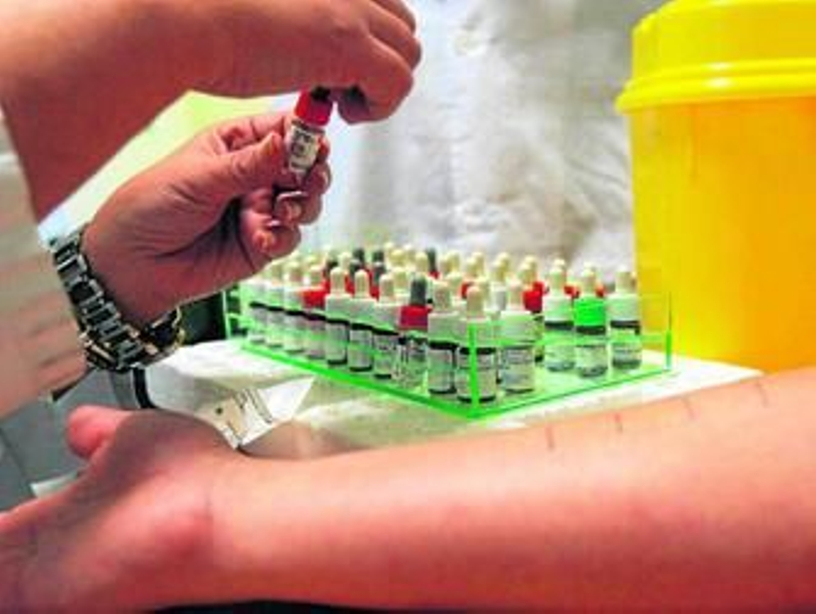 Un paciente se somete a las pruebas de la alergia en una imagen de archivo.