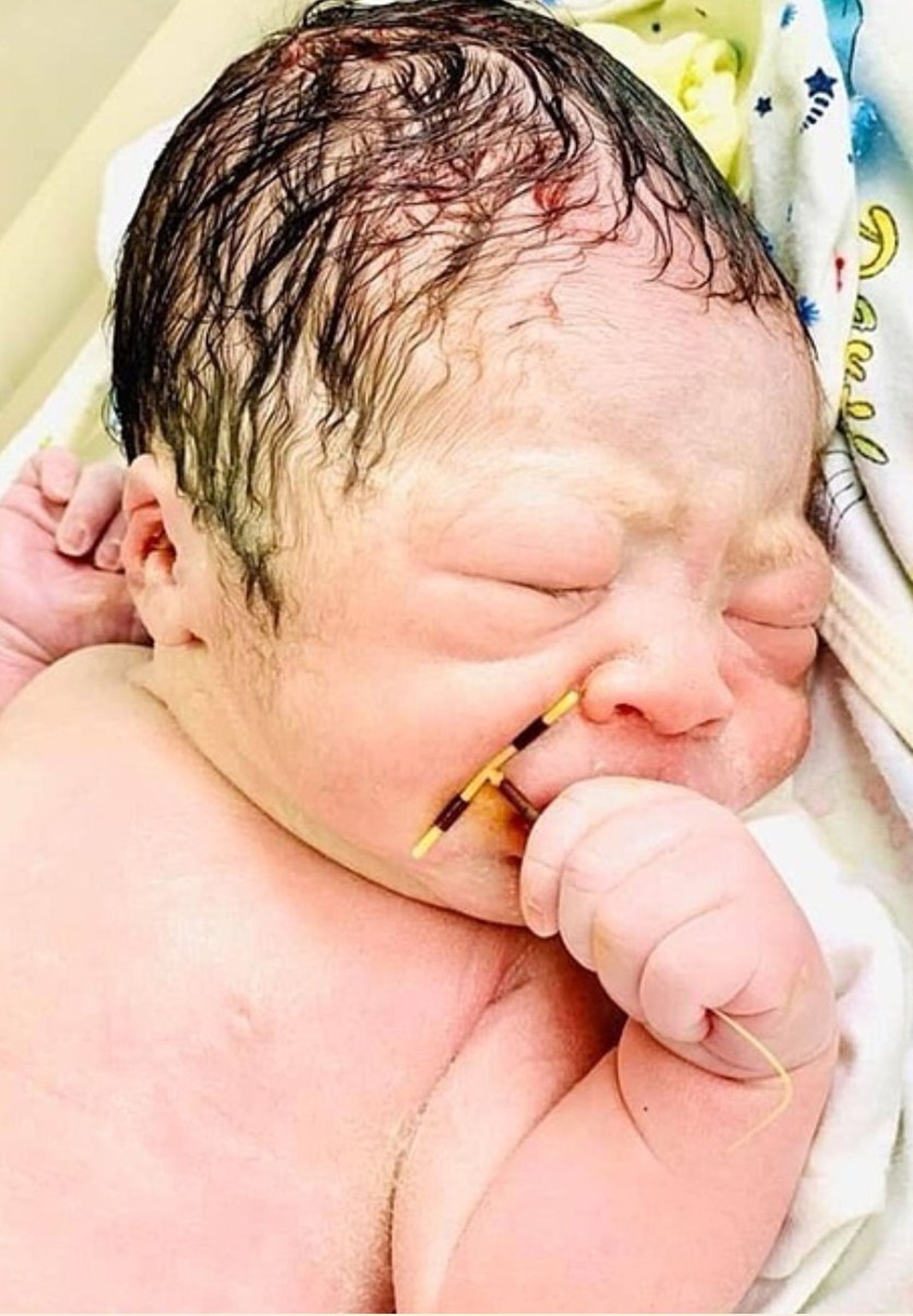 El bebé nacido con un DIU en Vietnam.