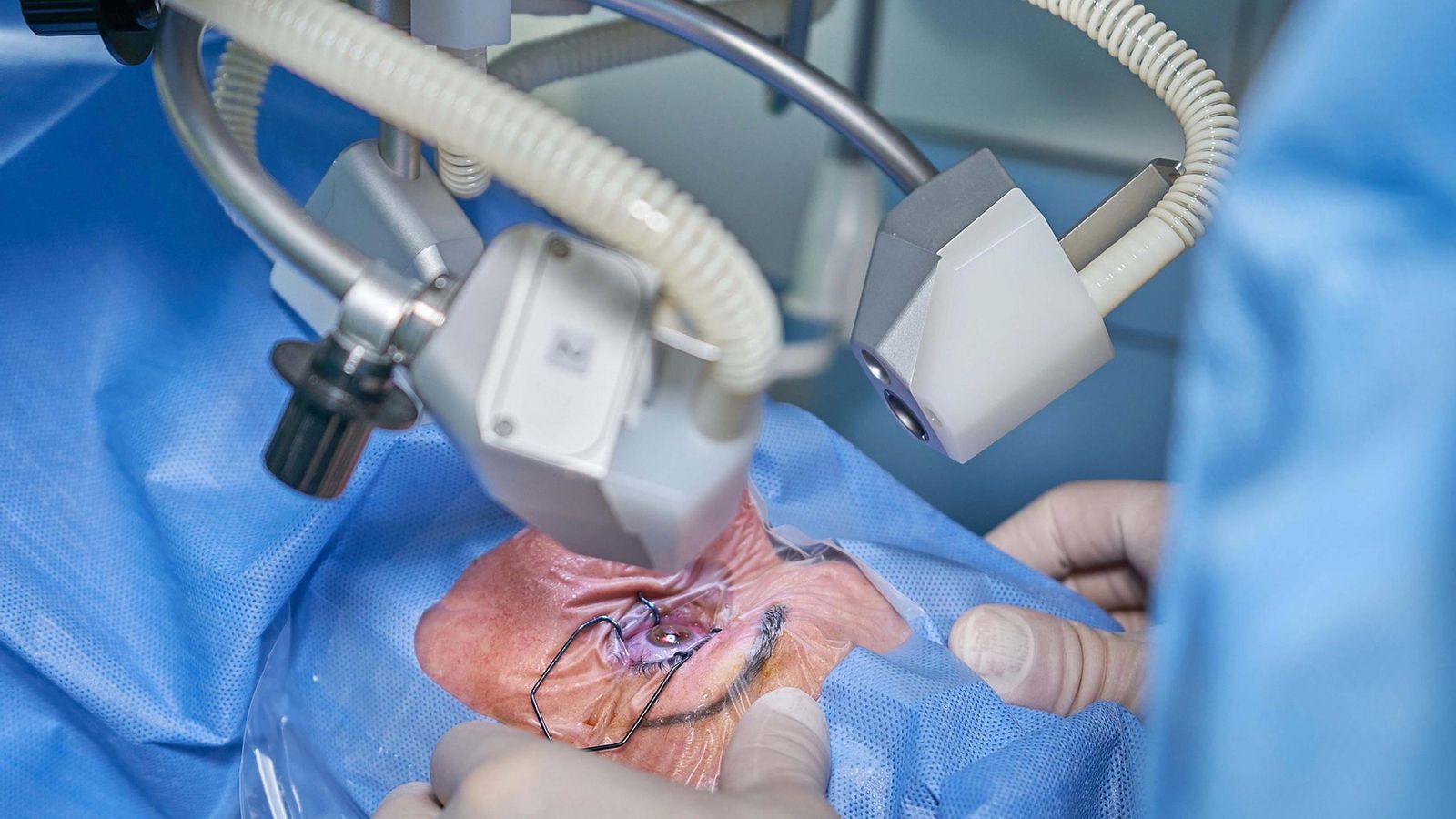 Una operación de cataratas, el procedimiento con más pacientes en lista de espera.