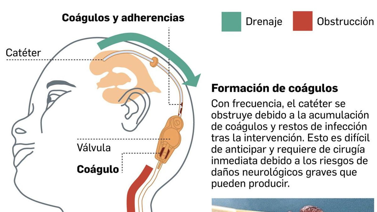 La obstrucción del catéter, su principal problema. Fuente: catedrático Emilio Gómez y neurocirujano Javier Márquez.