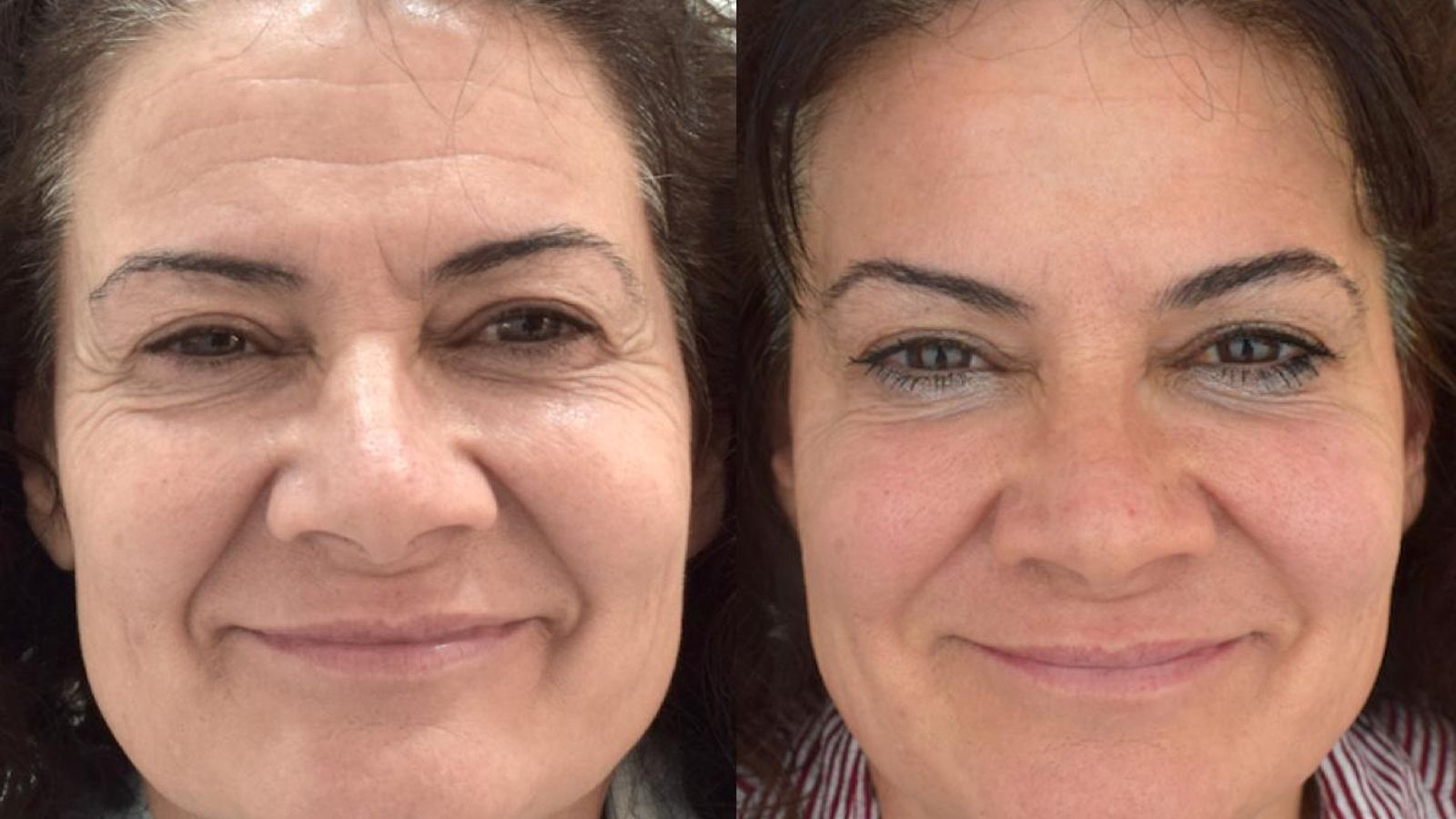 Técnicas de embellecimiento y rejuvenicimiento donde se deja patente la diferencia del antes y el después.