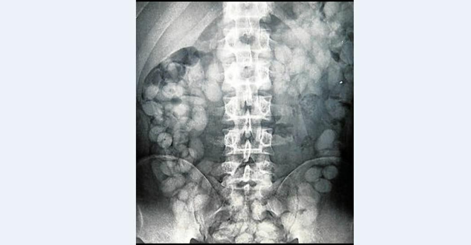 Radiografía en la que se observan las bellotas de hachís detectadas a un interno en la prisión de Botafuegos.