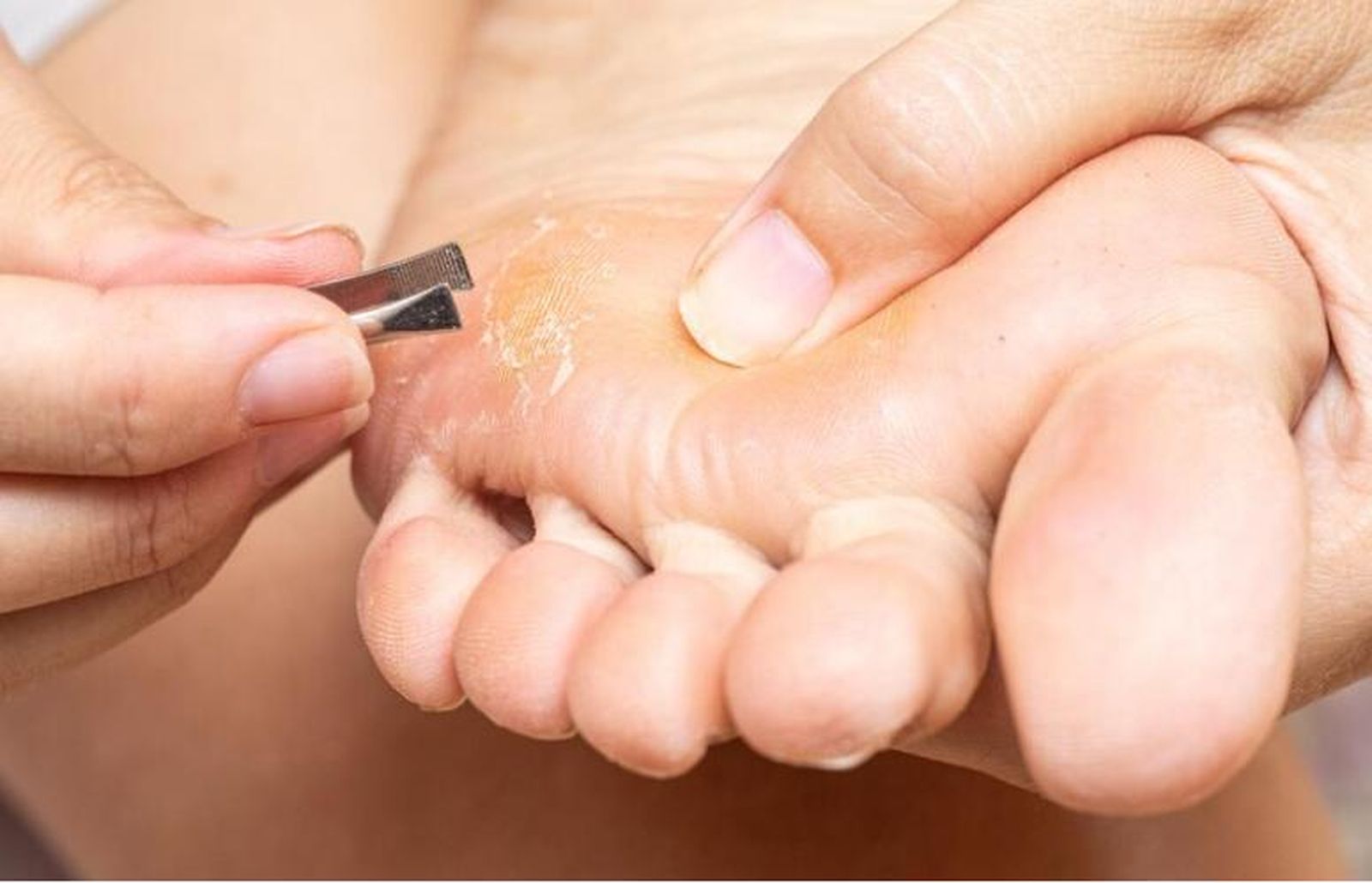 El eterno debate sobre las ampollas, la lesión más frecuente en verano: ¿es bueno pincharlas?, ¿Cómo curarlas  de manera efectiva?