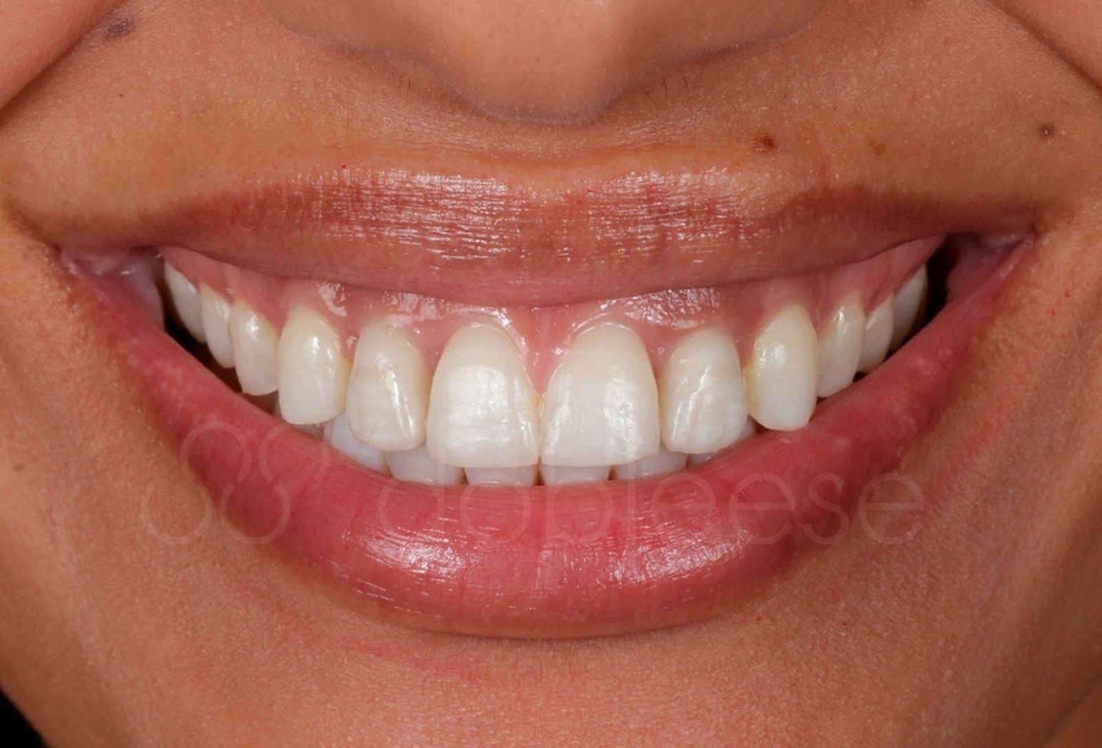 Porqué te interesan los implantes dentales con dientes provisionales desde el primer día