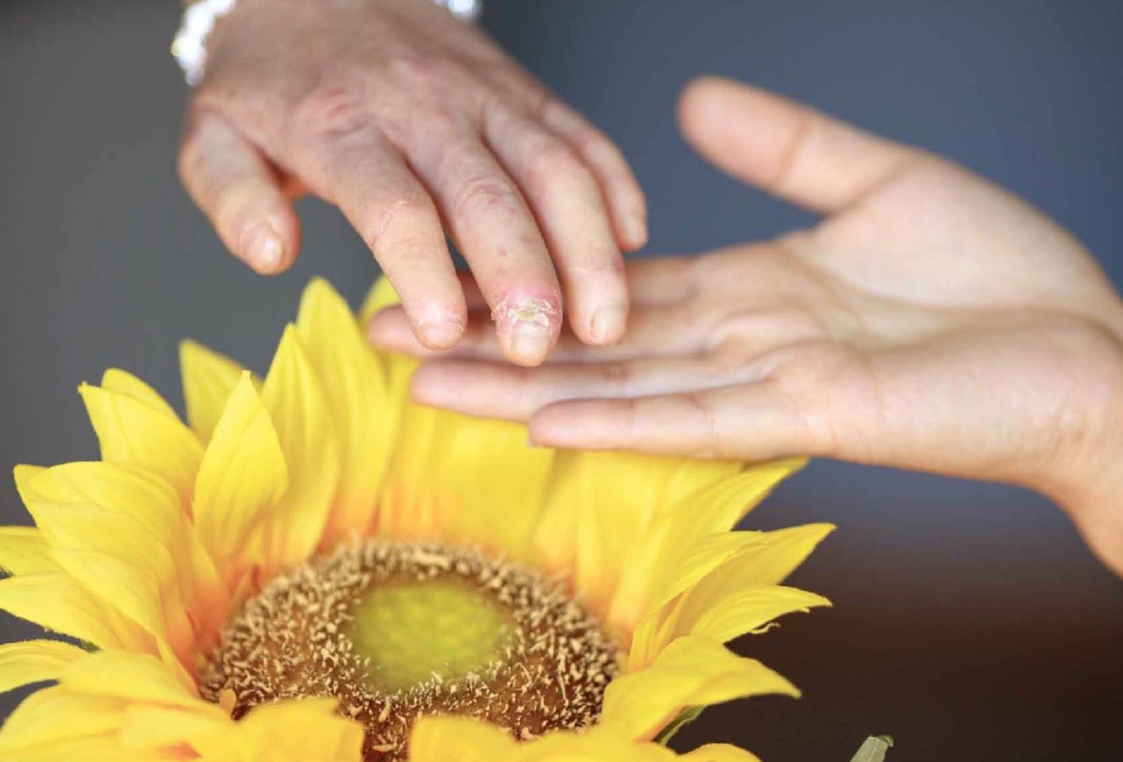 Además de afectar a órganos internos, la enfermedad produce sequedad e inflamación en piel y manos alterando el aspecto físico.