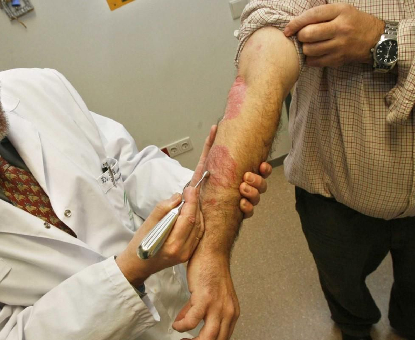 Un paciente con psoriasis.
