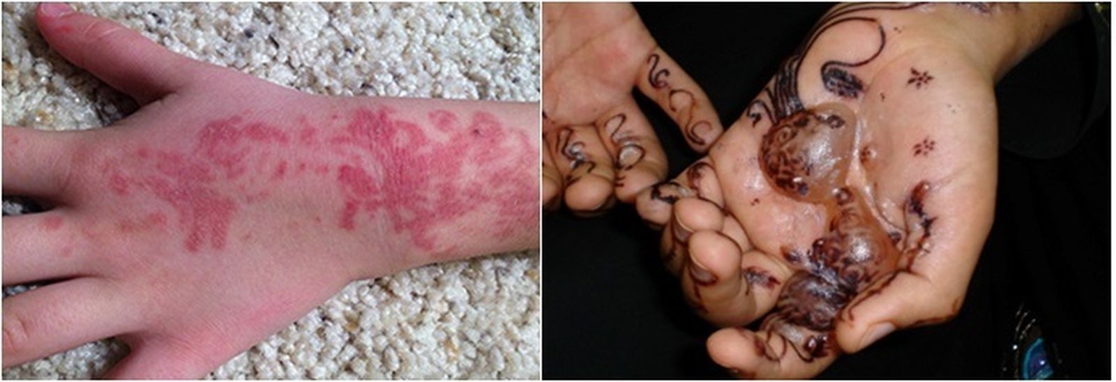 Los peligros de la henna negra en verano