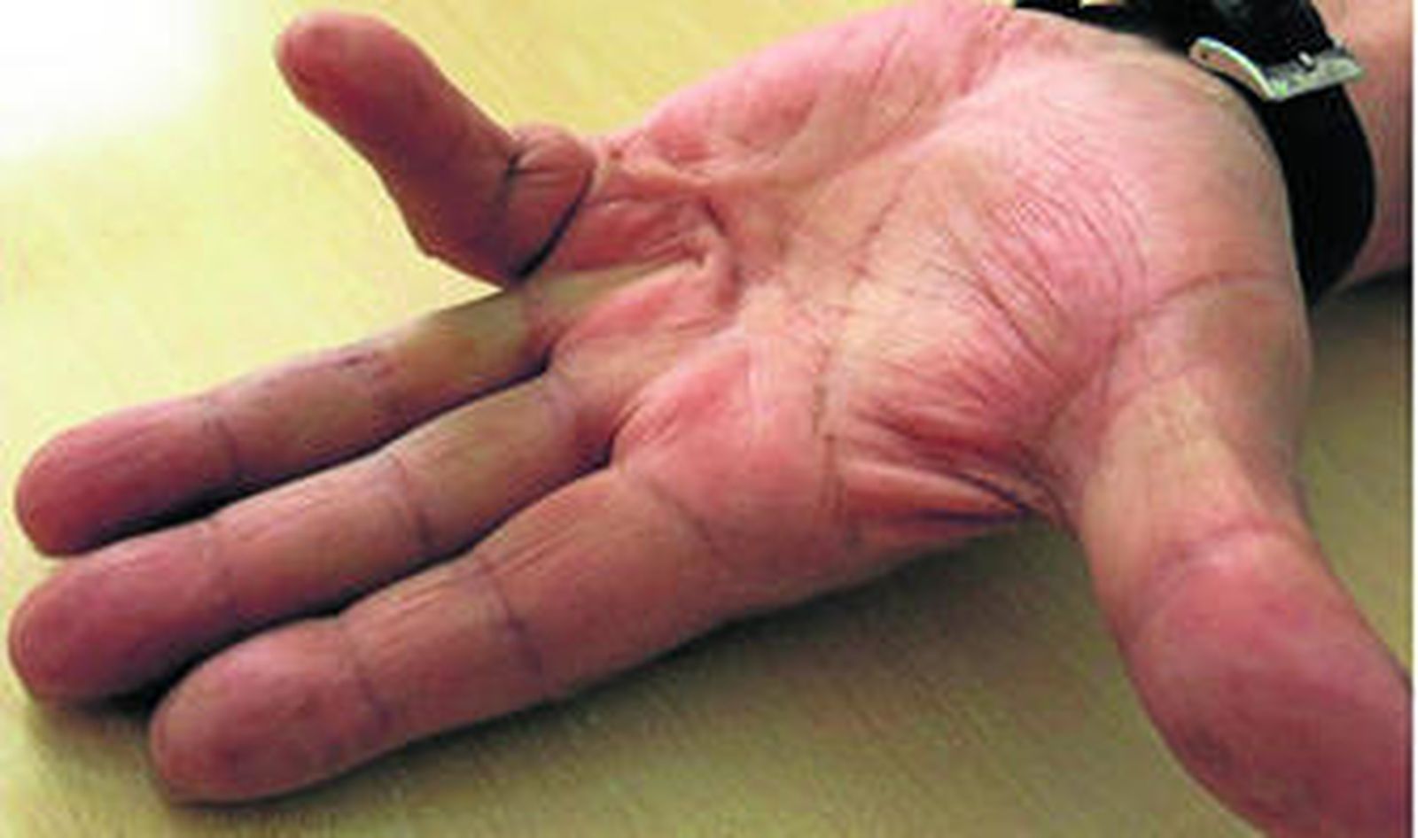 Imagen de una mano con la patología de Dupuytren y el tratamiento quirúrgico seguido.