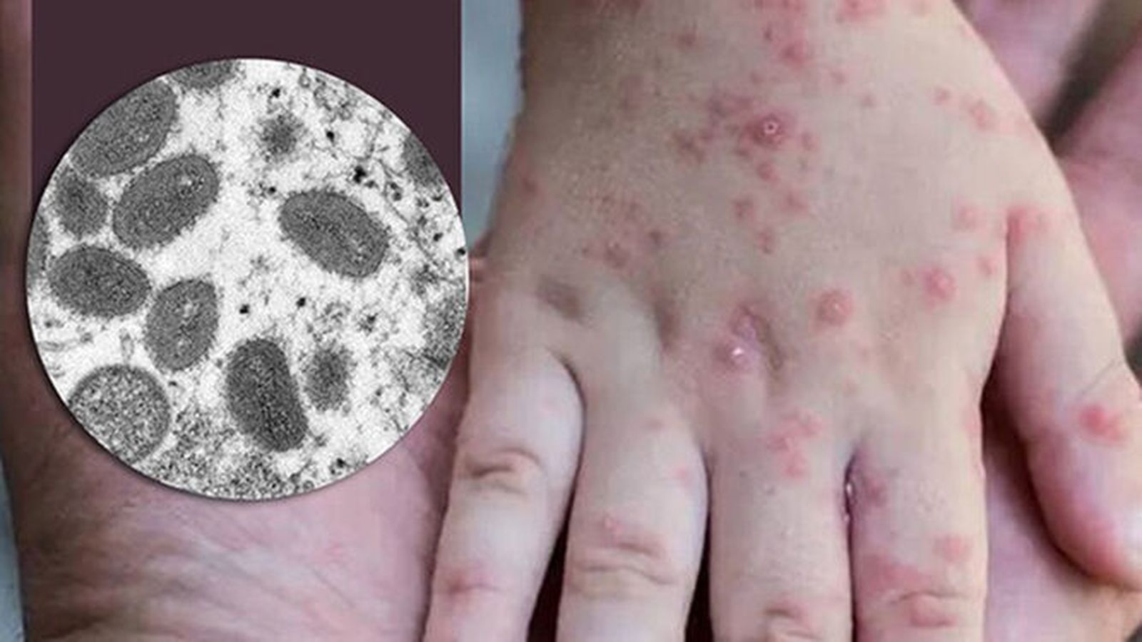 Una mano con las pústulas habituales de la viruela del mono