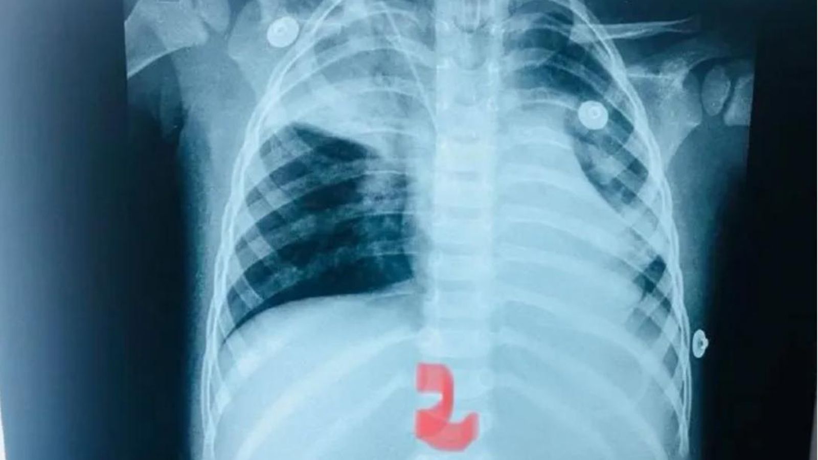 Radiografía neumonía