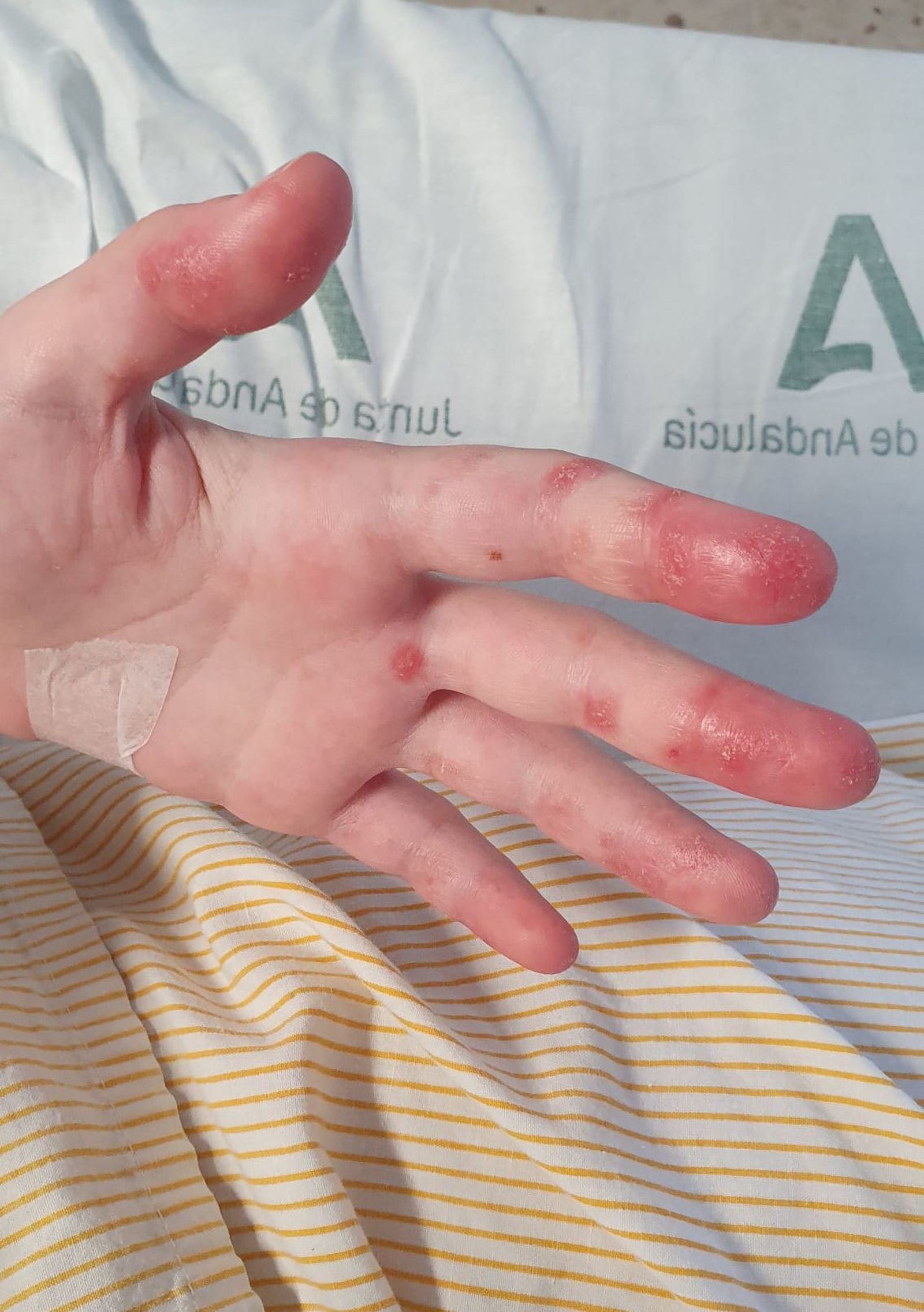 Lesiones por lupus en las manos.