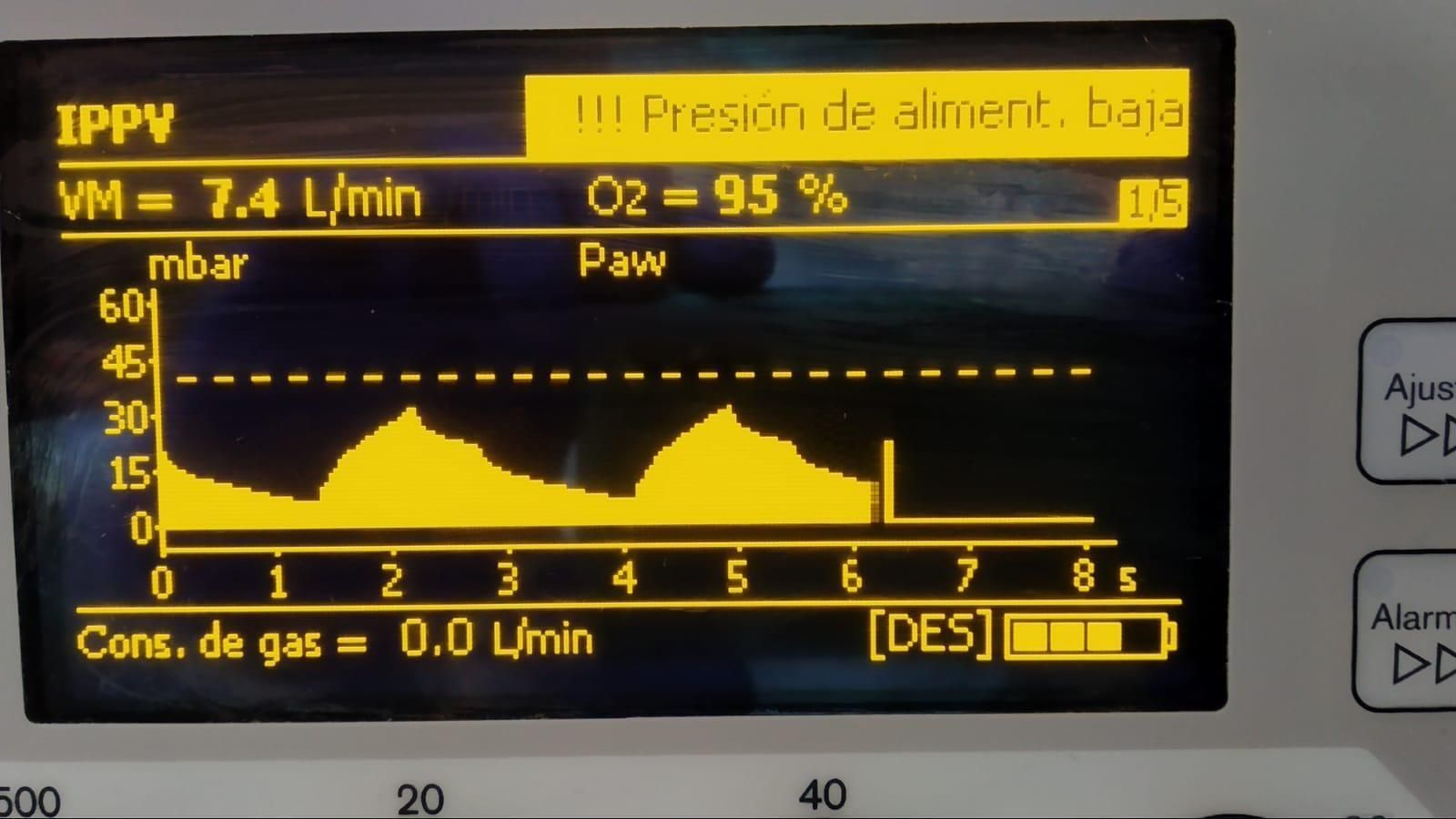 Imagen del ensayo clínico del respirador diseñado en Málaga, con un paciente en Antequera.