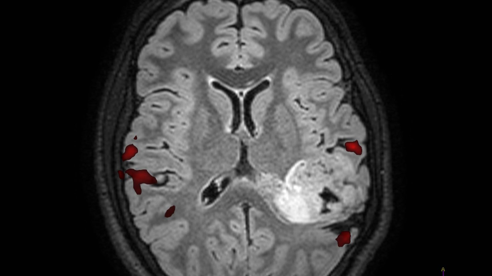 En las zonas rojas se aprecia las áreas del lenguaje. En la blanca, el tumor.