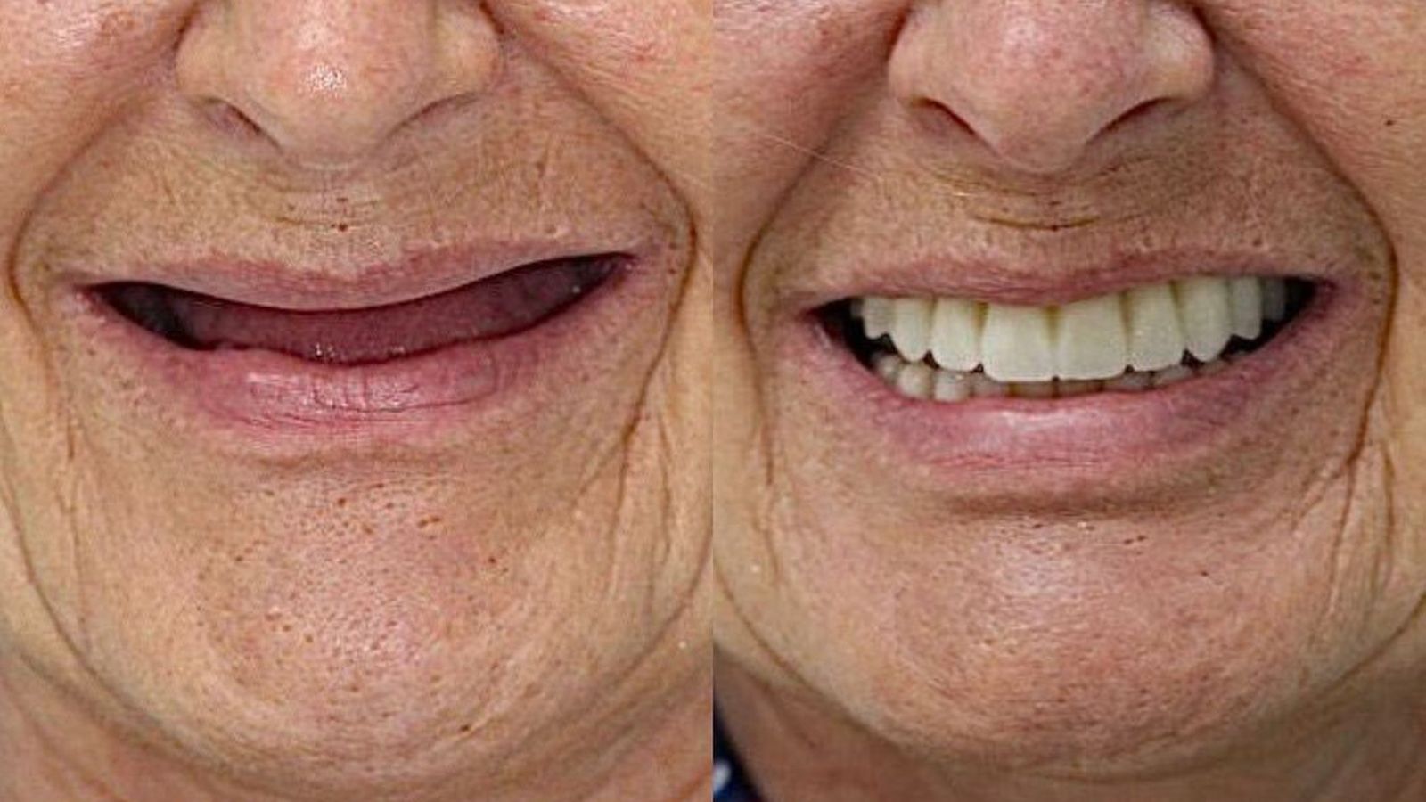 Imagen del antes y después de una paciente.