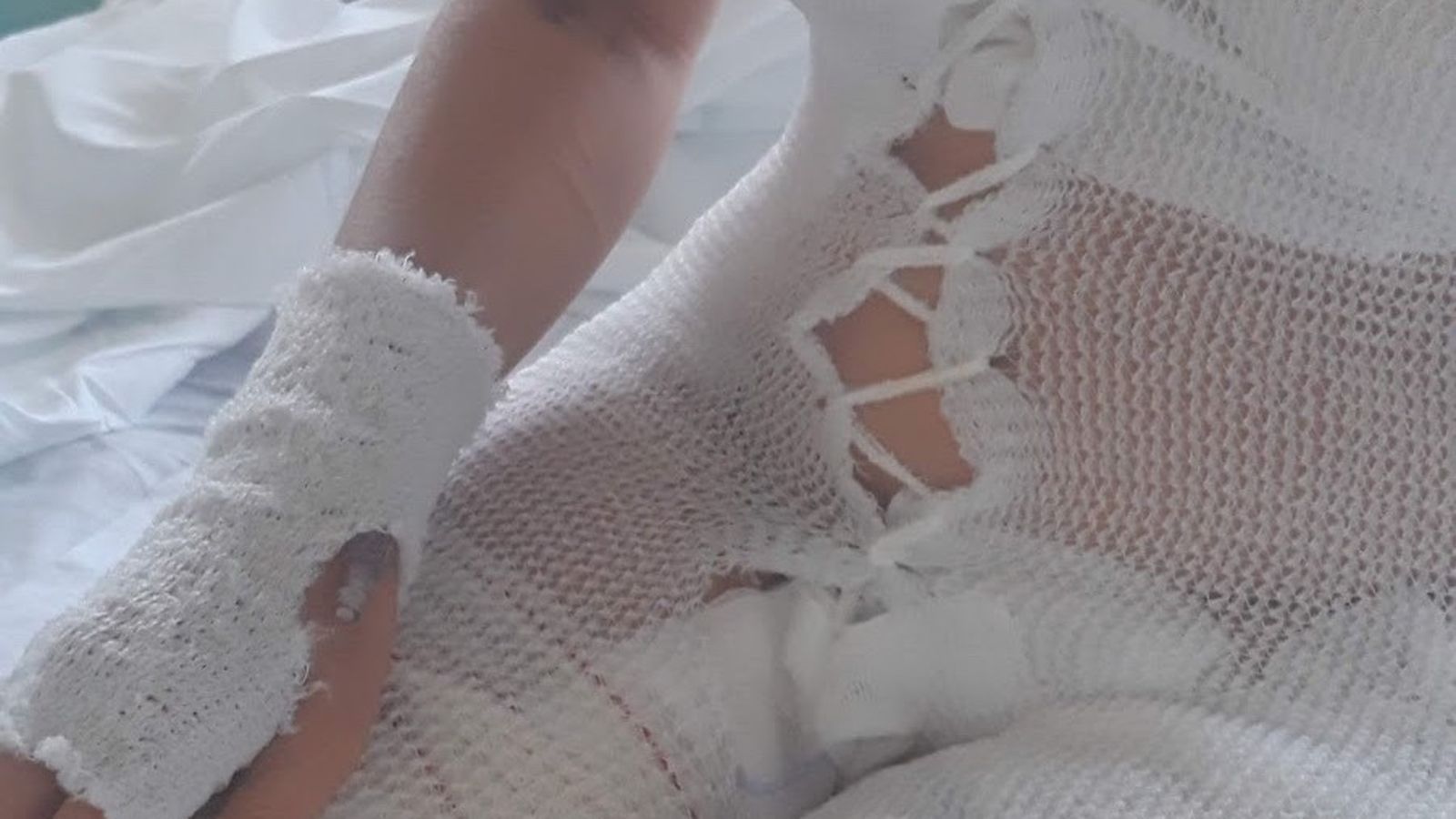 Silvia, con buena parte del cuerpo vendado durante su estancia en el hospital.