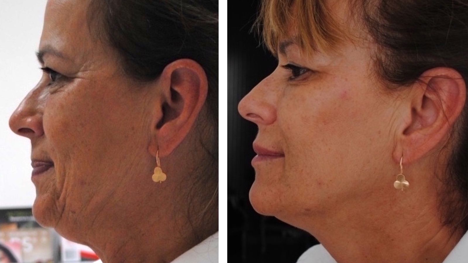 Rejuvenecimiento global del rostro con técnica 4x9 sin cirugía Dr. Kosmecki (Clínicas Verkomed).