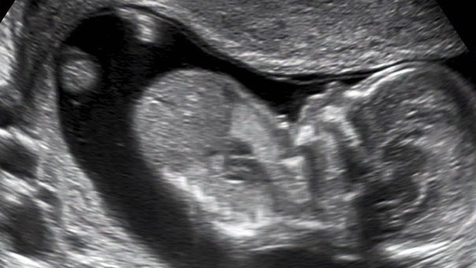 Imagen ecográfica del primer trimeste de gestación.