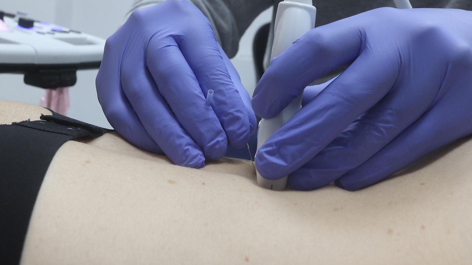 Detalle de uno de los tratamientos con agujas.