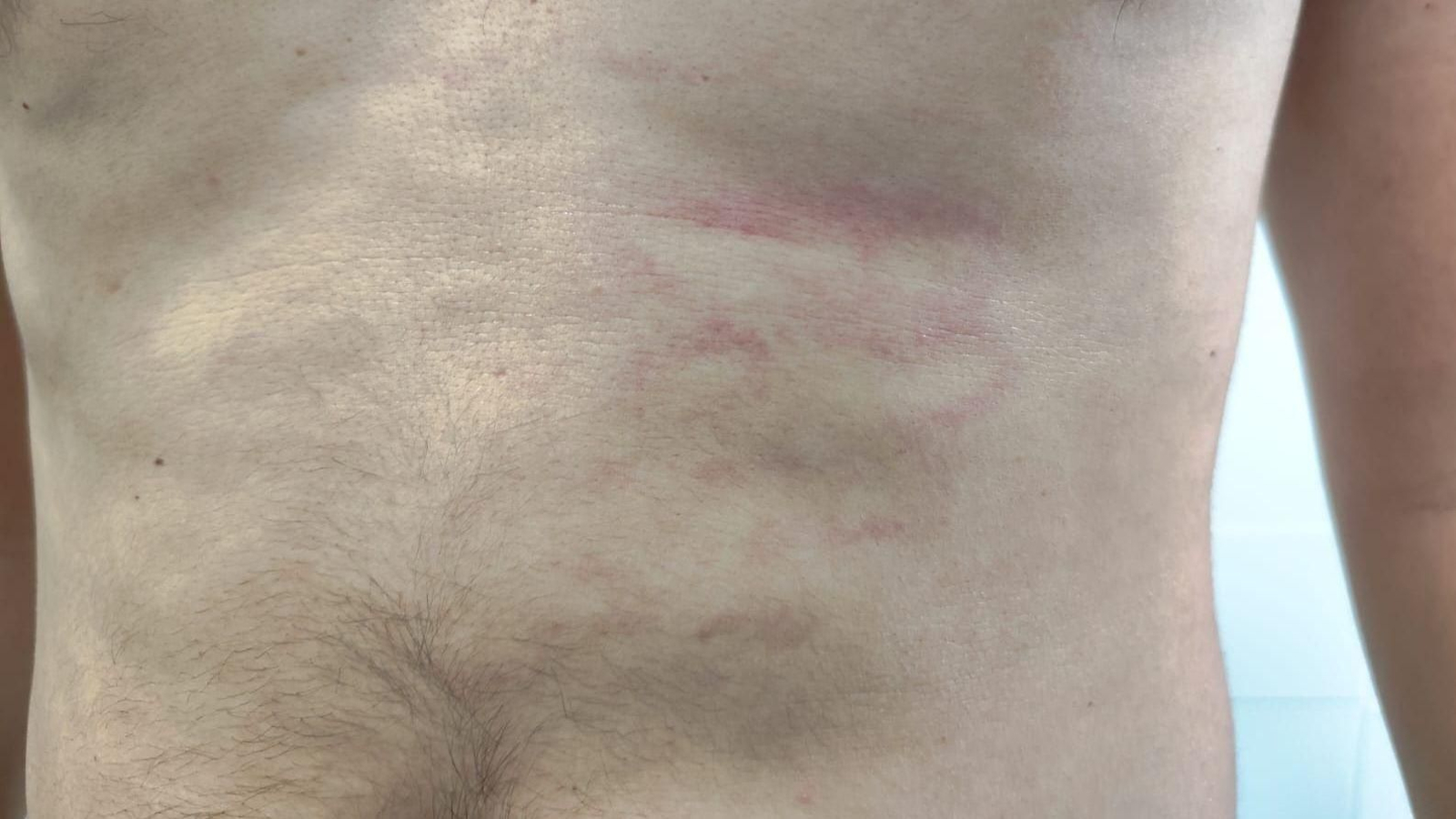 El abdomen del árbitro agredido, en una imagen facilitada por el CTA a 'Europa Sur'