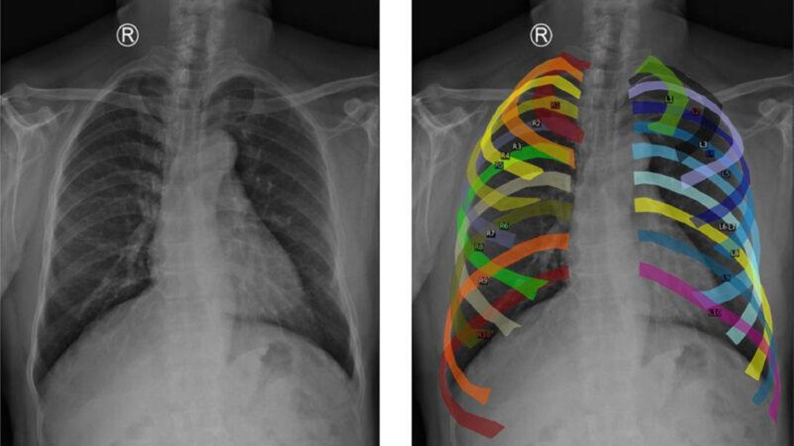 Una radiografía de tórax, pasada por el modelo de IA.