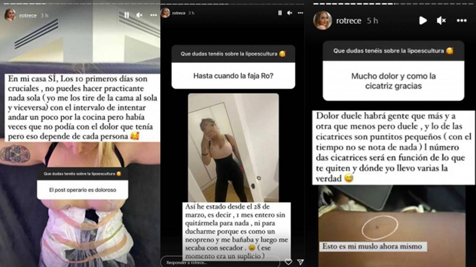 Rocío Flores comparte el postoperatorio a través de sus Stories Rocío Flores comparte el postoperatorio a través de sus Stories