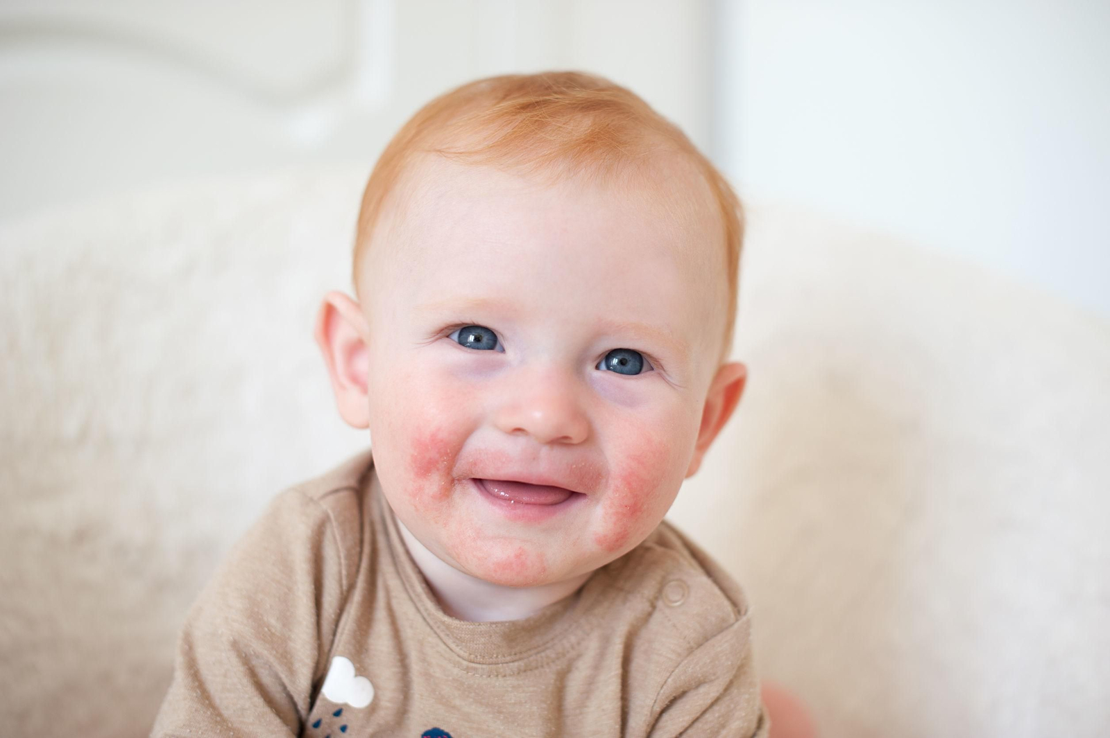 La dermatitis atópica, manifestación de la atopía en la piel, es la enfermedad inflamatoria más común en los niños.