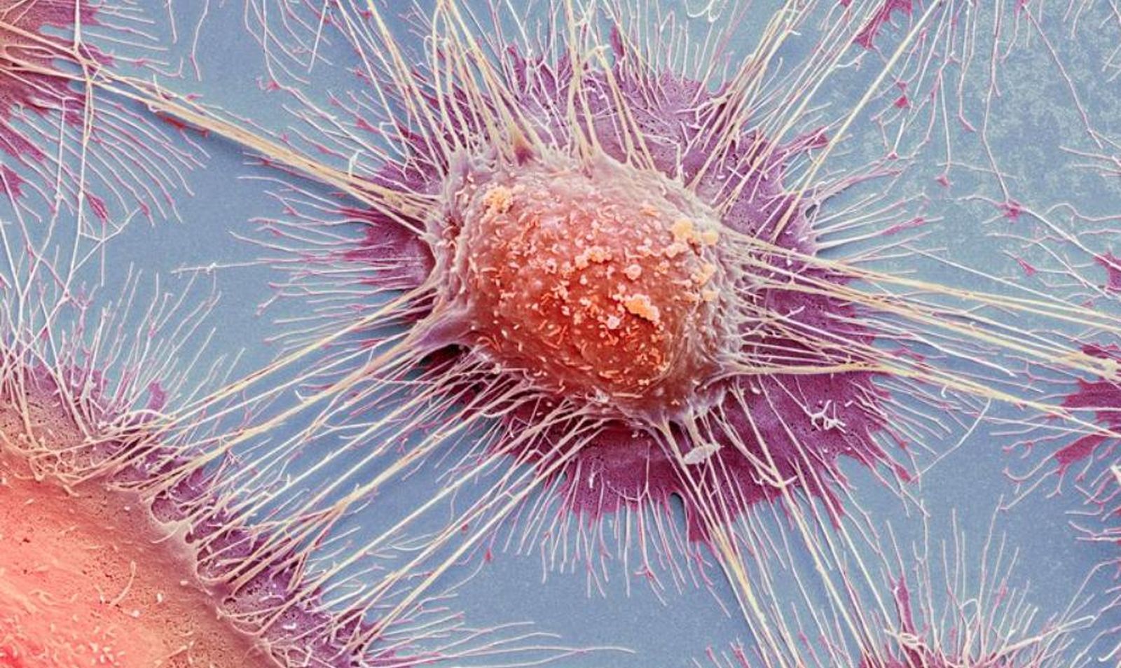 Vista al microscopio de un tipo de carcinoma.