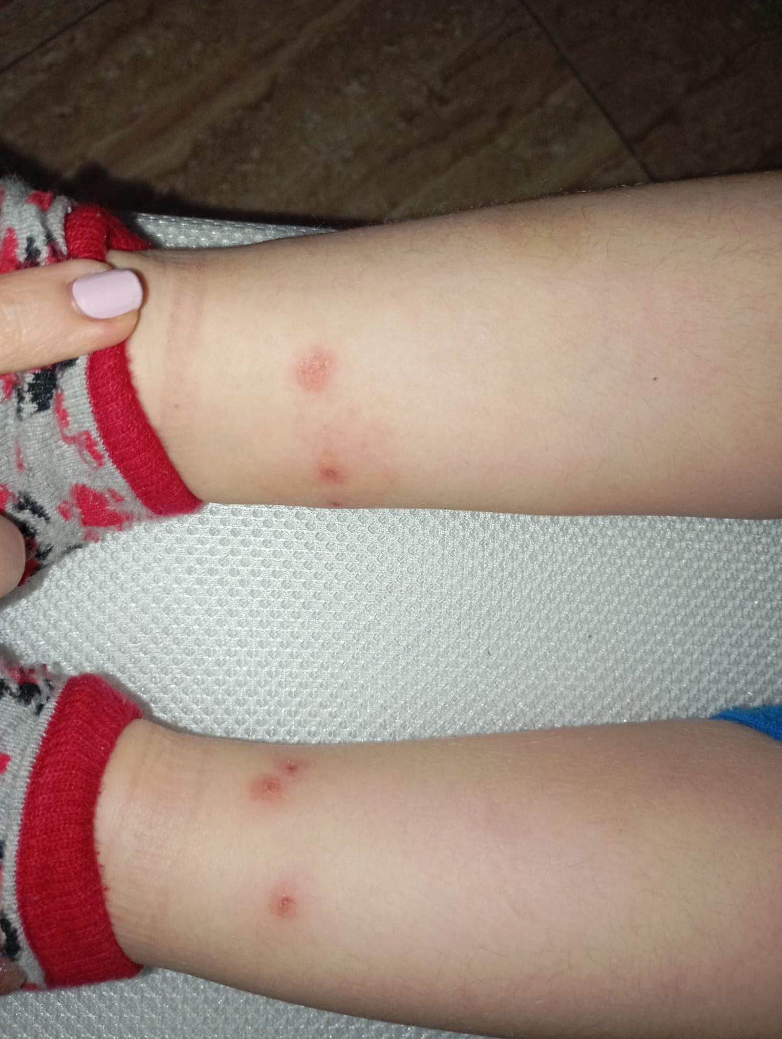 Estado de las heridas que presentan los niños afectados por la plaga de pulgas.