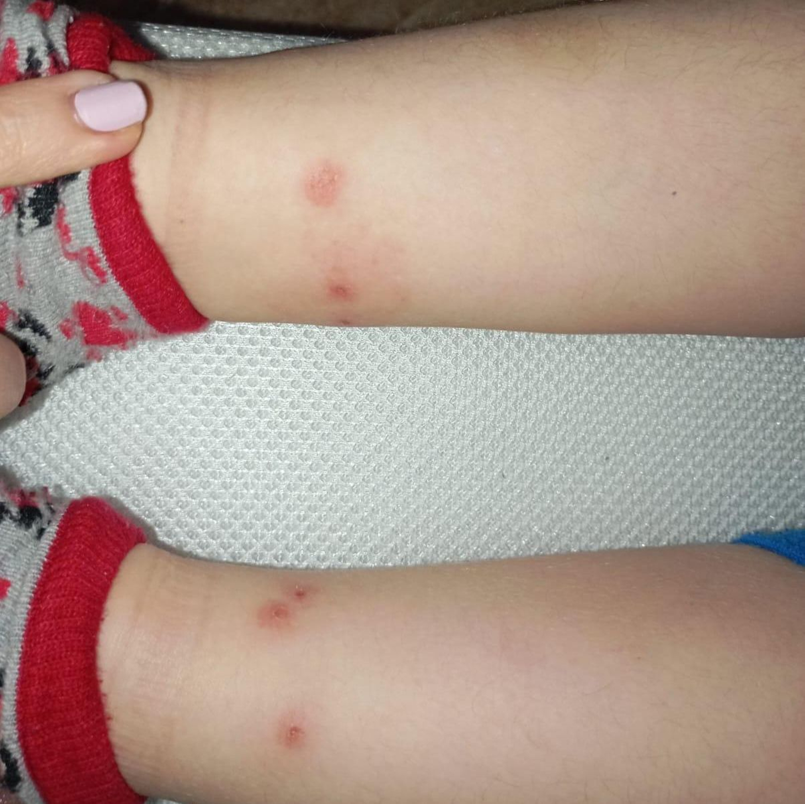 Estado de las heridas que presentan los niños afectados por la plaga de pulgas.
