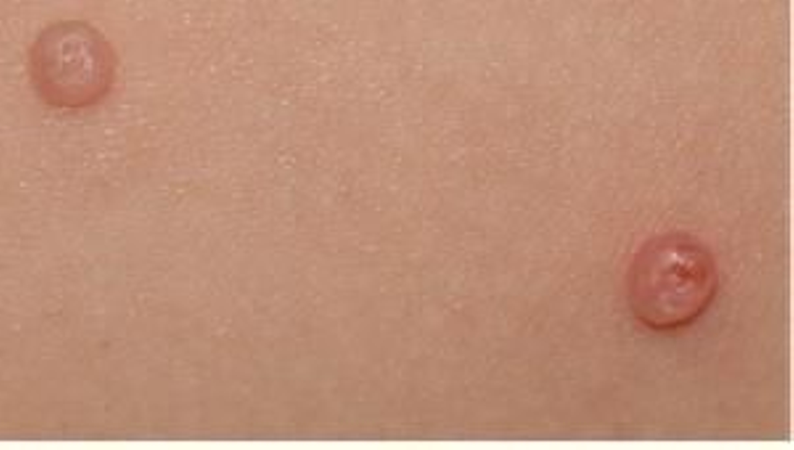 Pápulas de molusco.